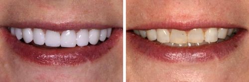 Before and After Smiles from a Local Patient for Cosmetic Dentist Near Highland