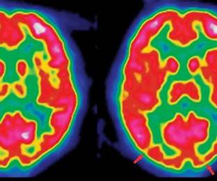 https://www.tmc.edu/news/wp-content/uploads/sites/2/2019/06/autism-brain-scan-1.jpg