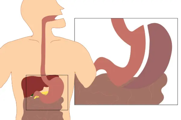 Medical illustration of sleeve gastrectomy, with most of the stomach removed and the remaining portion shaped into a narrow sleeve-like tube.