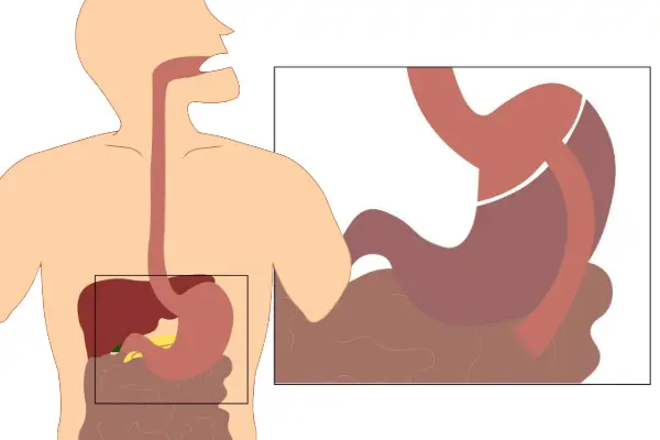 Diagram showing gastric bypass surgery, where a small pouch of the stomach is connected directly to the small intestine, bypassing the majority of the stomach.