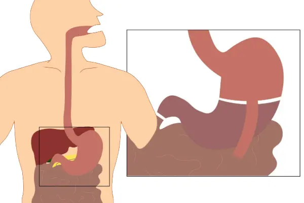 Illustration of duodenal switch surgery, showing both a sleeve-shaped stomach and significant intestinal rerouting to reduce calorie absorption.