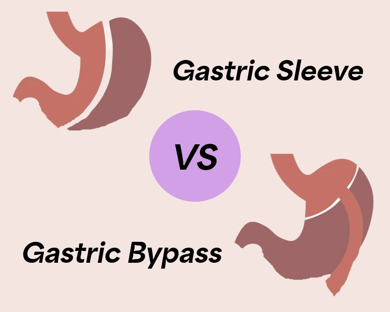 Comparison of gastric sleeve vs gastric bypass surgery showing reduced stomach size and intestinal rerouting.