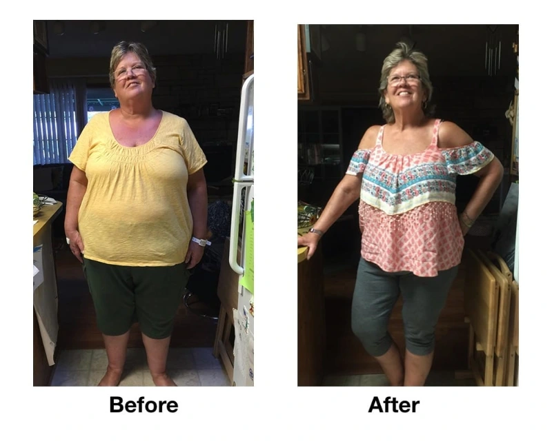 57-year-old Gastric Sleeve Patient Drops 100 Pounds After Surgery