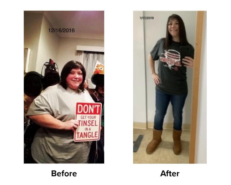 Gastric Sleeve Surgery Saved My Life