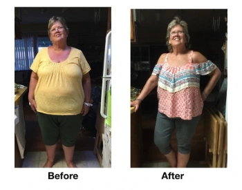 Before and after photos of Denise Brown, a 57-year-old gastric sleeve patient who lost 100 pounds.