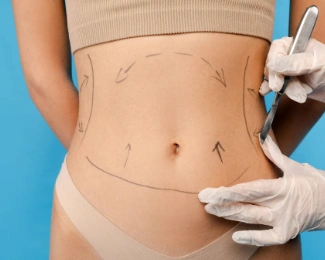 Surgeon with gloved hands marking a patient’s abdomen with a surgical pen during pre-operative preparation.