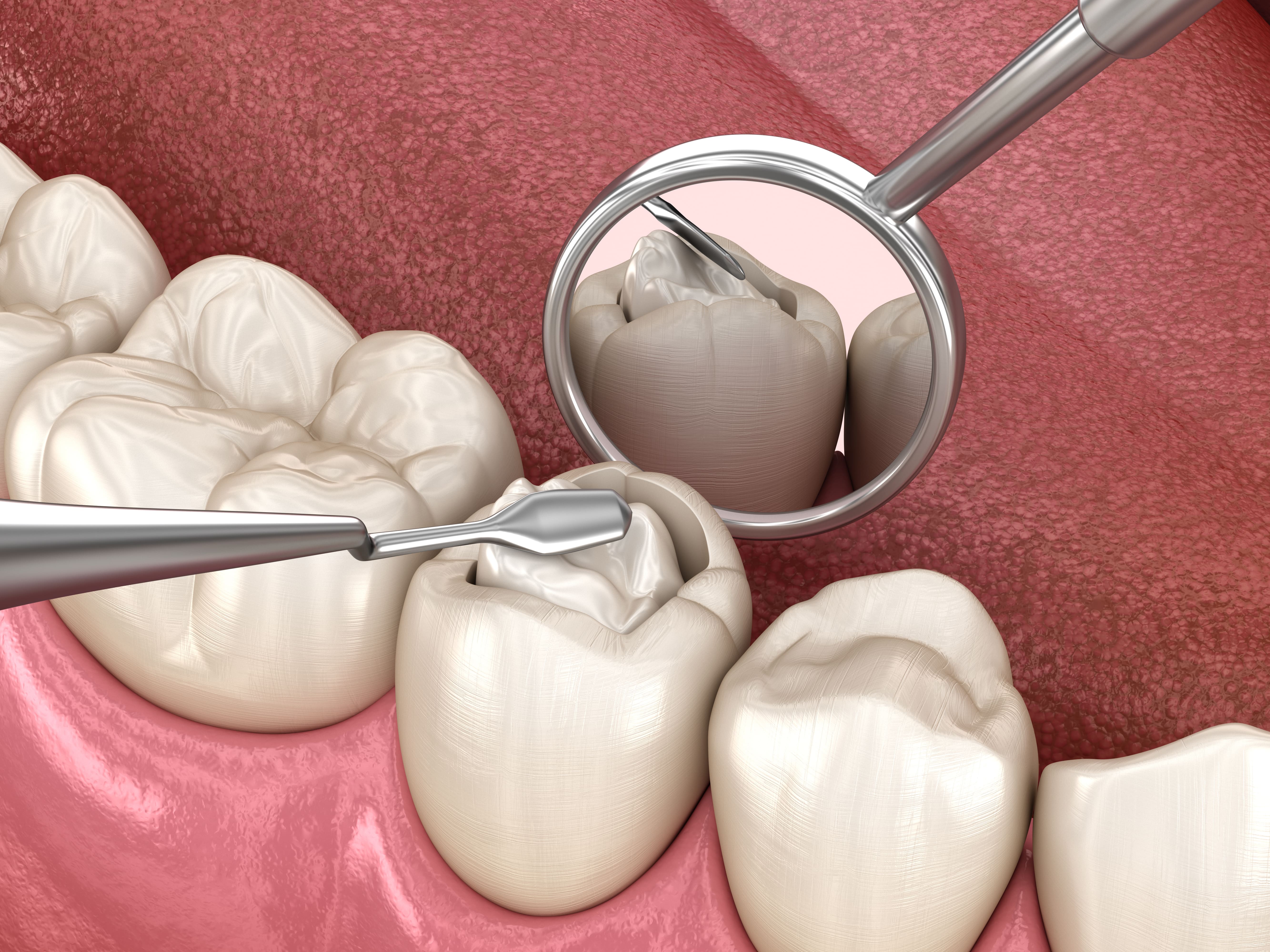 When Dental Fillings Fail: Expert Advice on Preventive Care