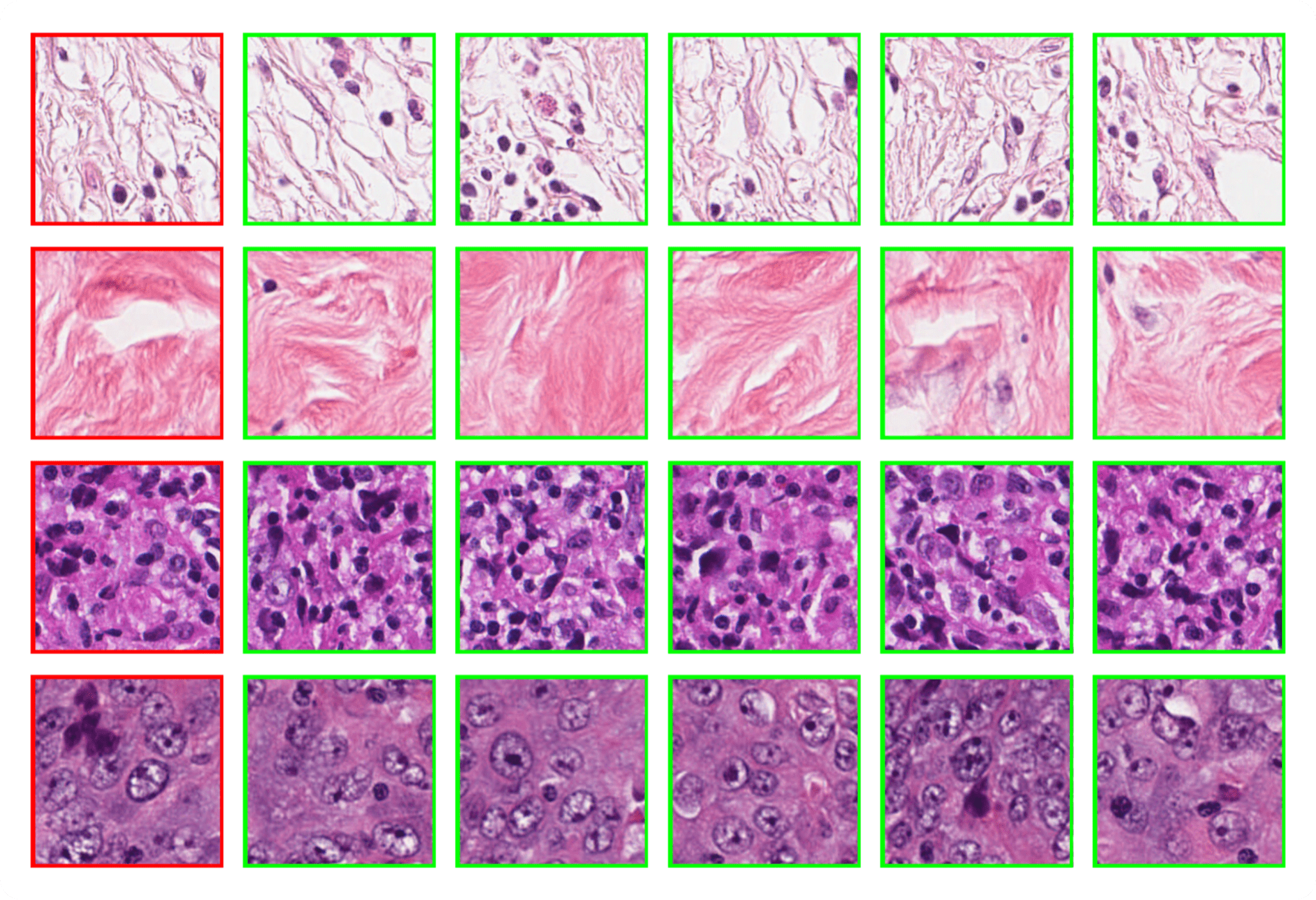 Figure 2. Nearest neighbor retrieval with Phikon-v2. The query tile (highlighted in red) is embedded using the Phikon-v2 encoder, and its five most similar tiles (highlighted in green) are retrieved based on cosine similarity in the embedding space.