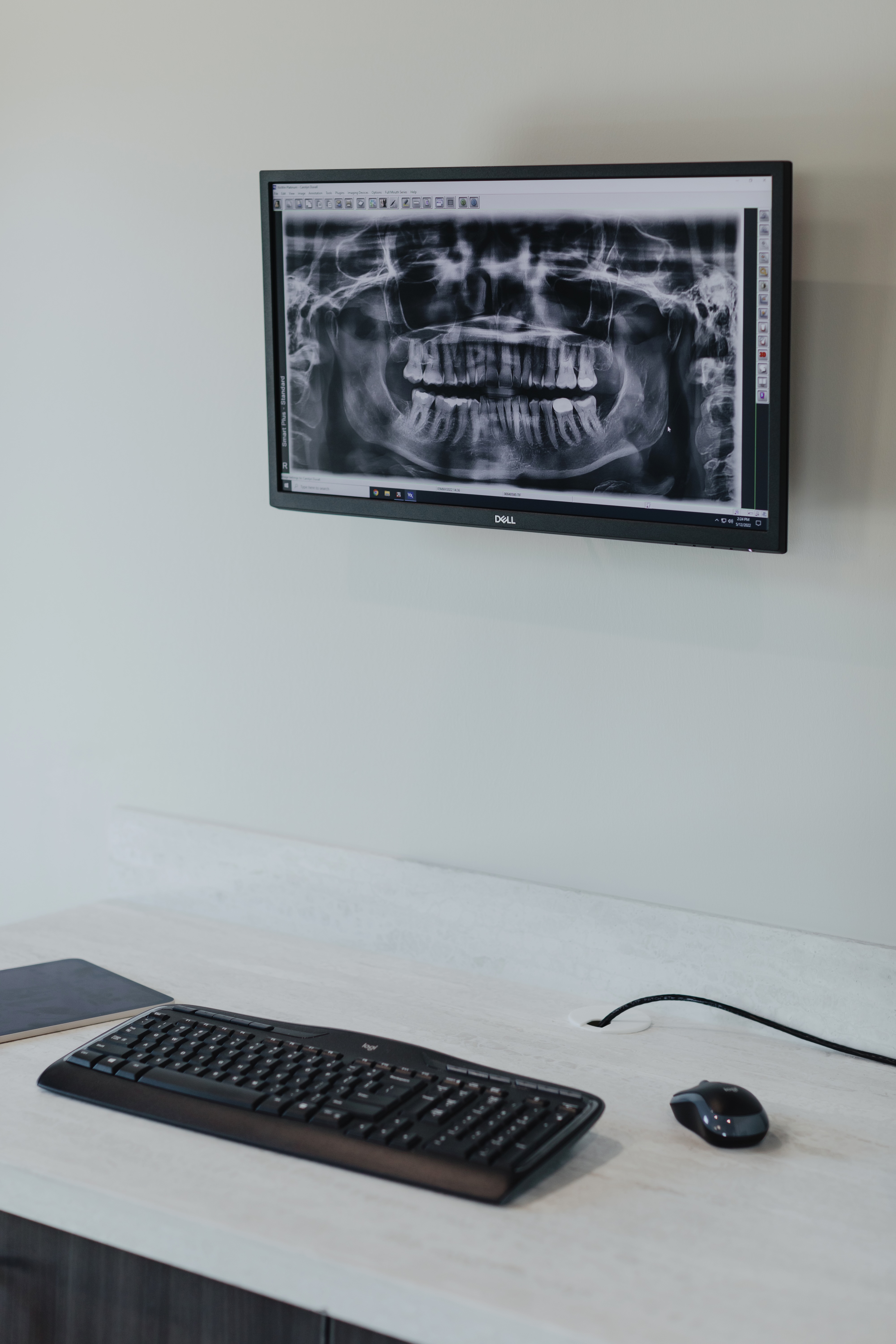 An Image of someones dental X-Ray displayed on a tv on the wall of the dental office