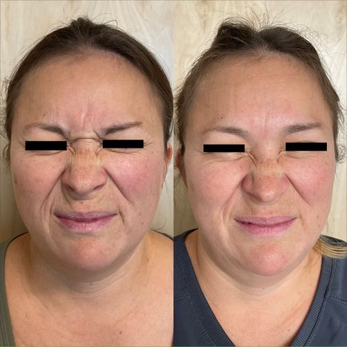 xeomin treatment reno NV
