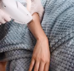 laser hair removal on woman hand
