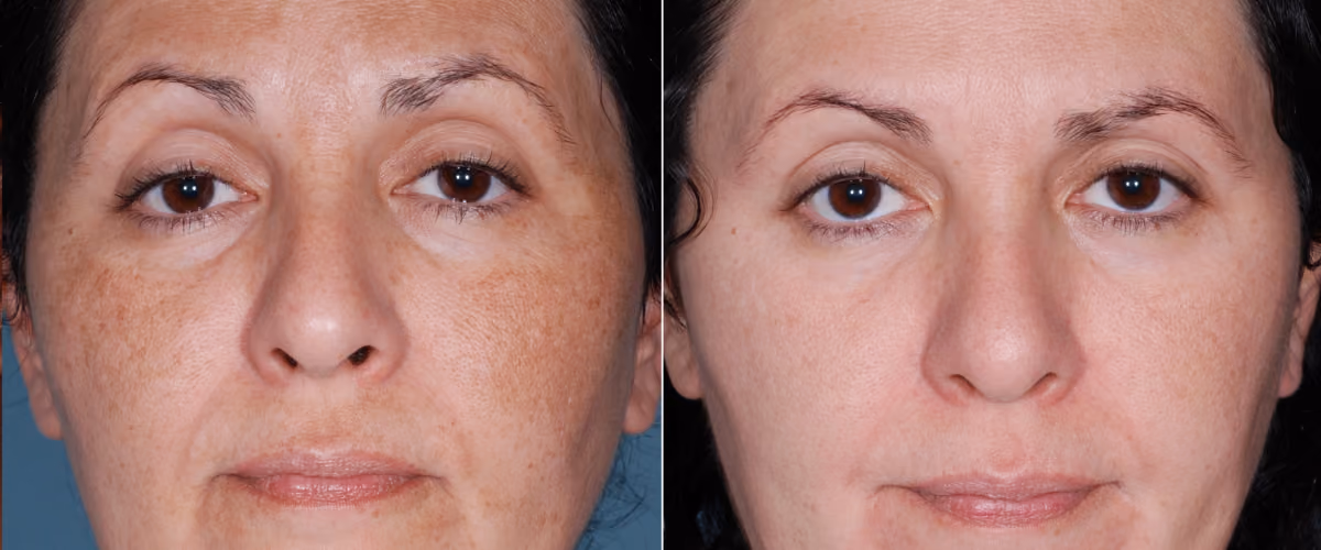 Side-by-side before and after close-up photos of a woman's face showing reduced dark spots and a more even skin tone in the after image.