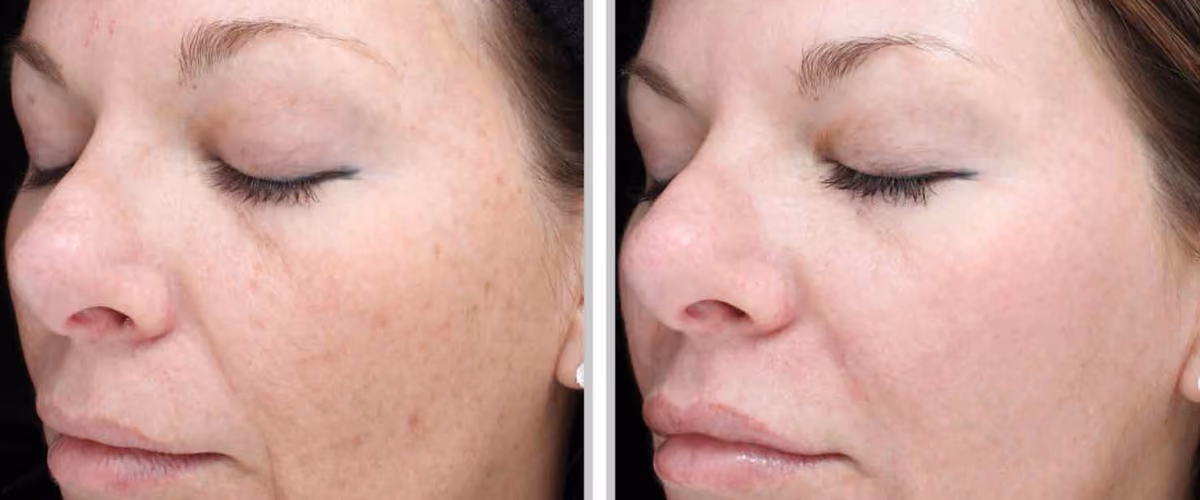 woman face before and after led light therapy