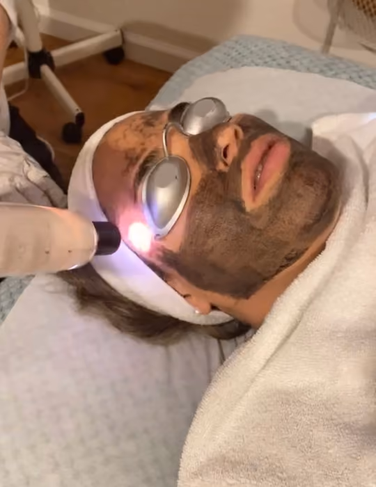 Person lying on a bed with a dark facial mask and protective goggles receiving a facial laser treatment near the temple by a device emitting purple light.