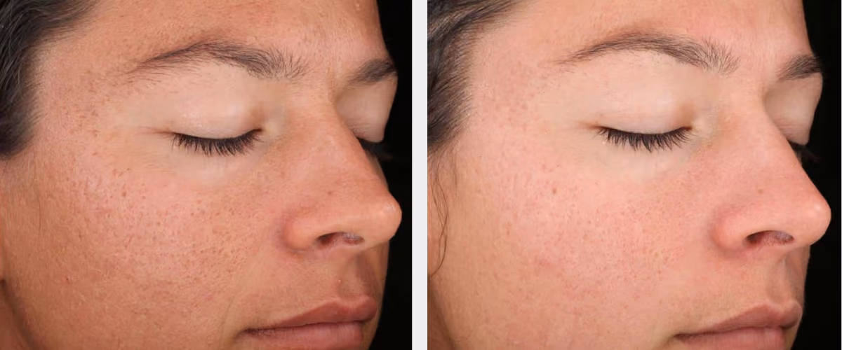 carbon peel before after