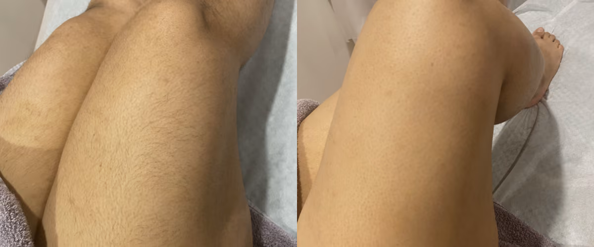 laser hair removal before after
