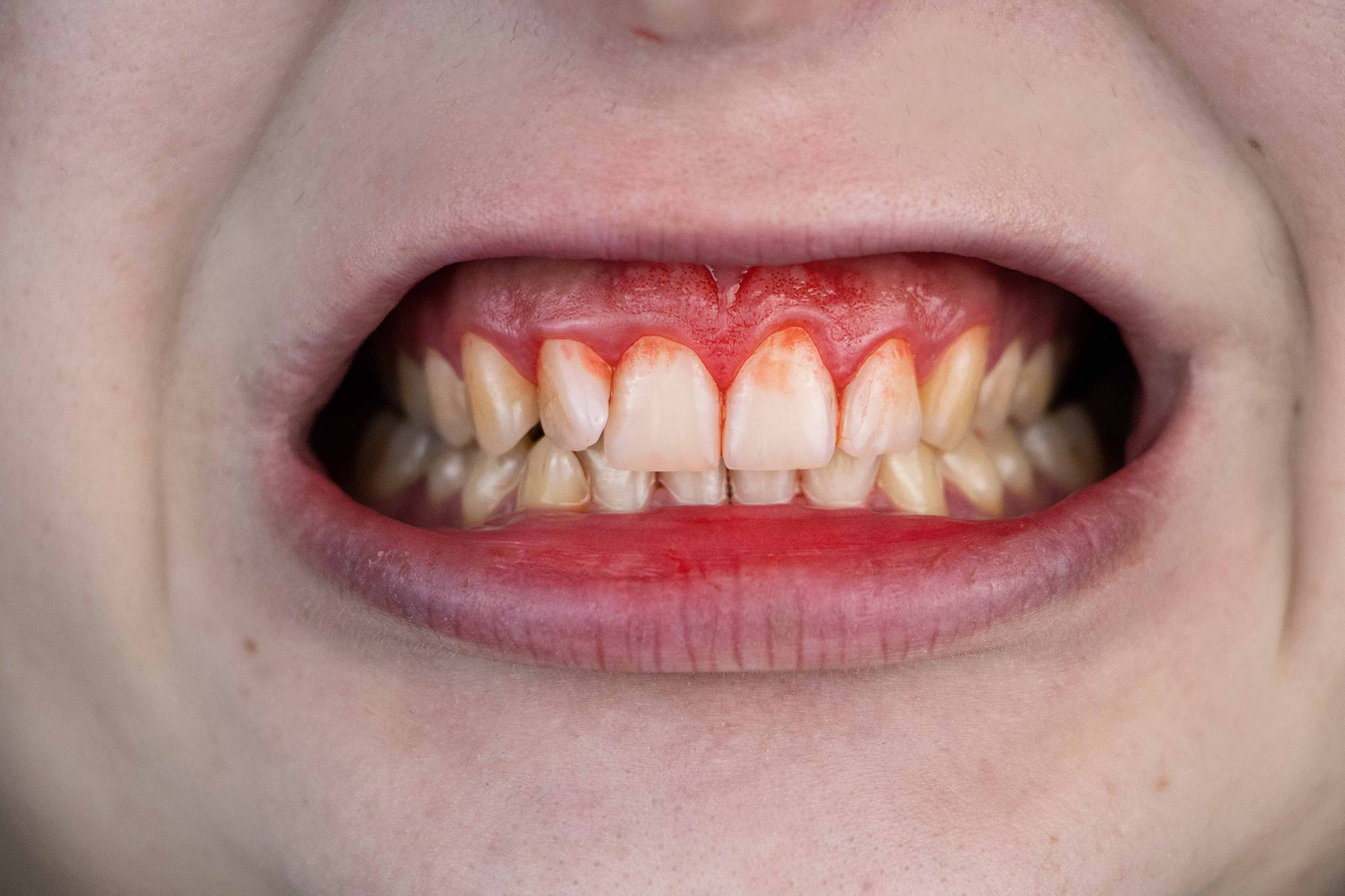 a smile photo of someone's teeth. their gums are all inflammed and bleeding