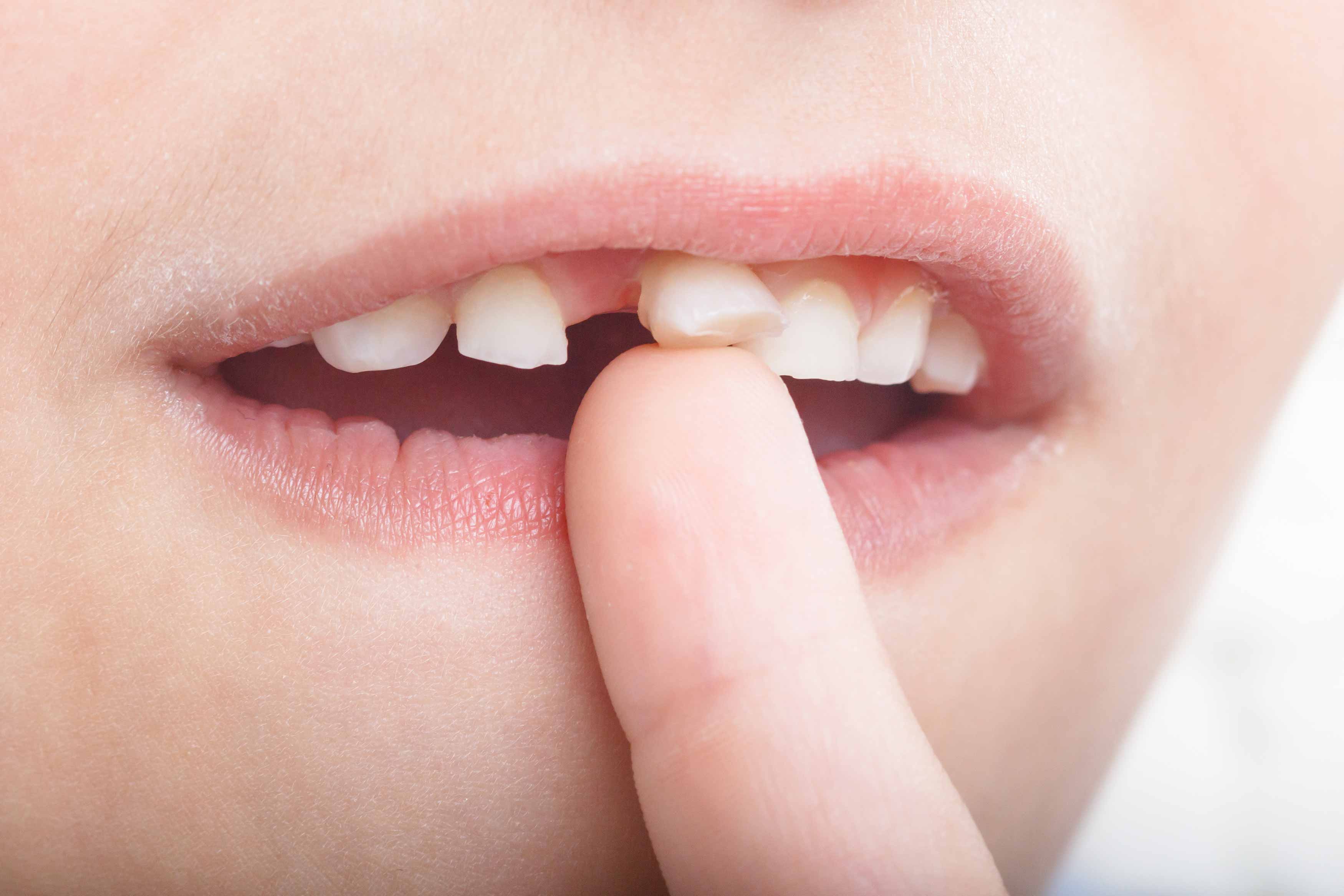 a photo of a kid wiggling his loose front right upper tooth