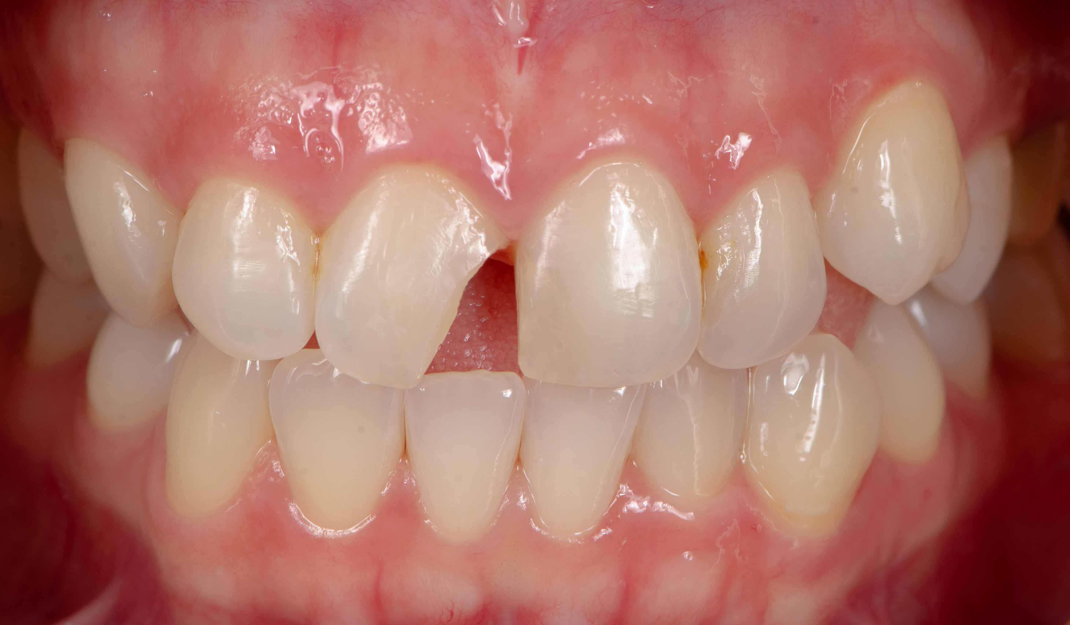 Upclose photo of someone's mouth showing part of their upper right central incisor missing