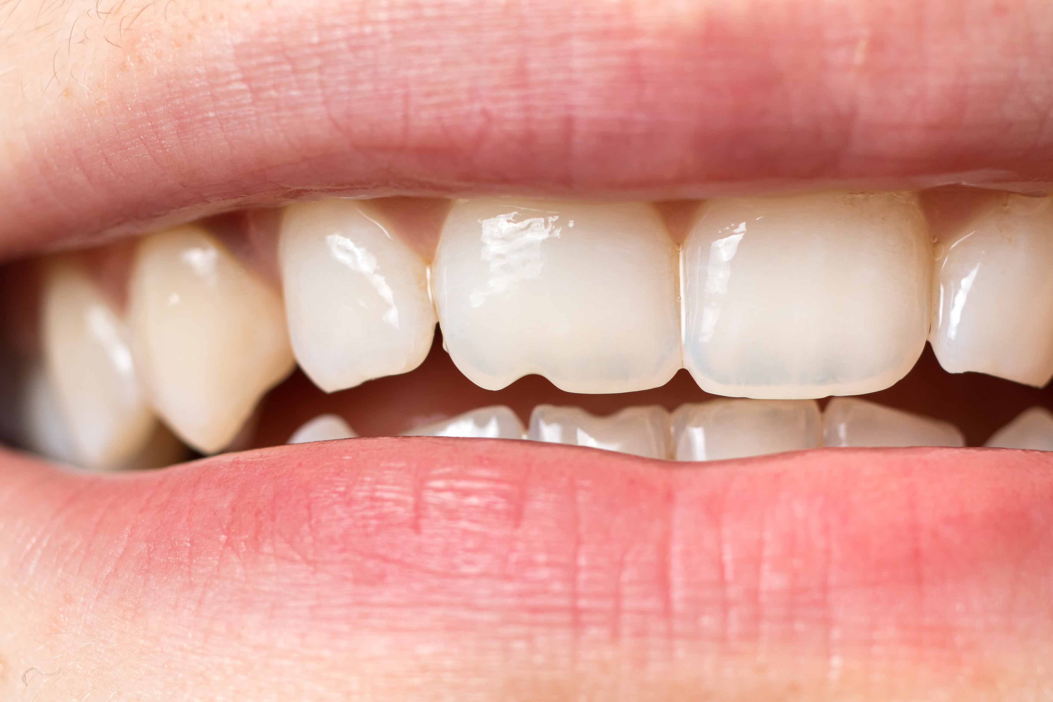 Upclose photo of someone's teeth showing the bottom part of their upper right central incisor chipped and is sharp 