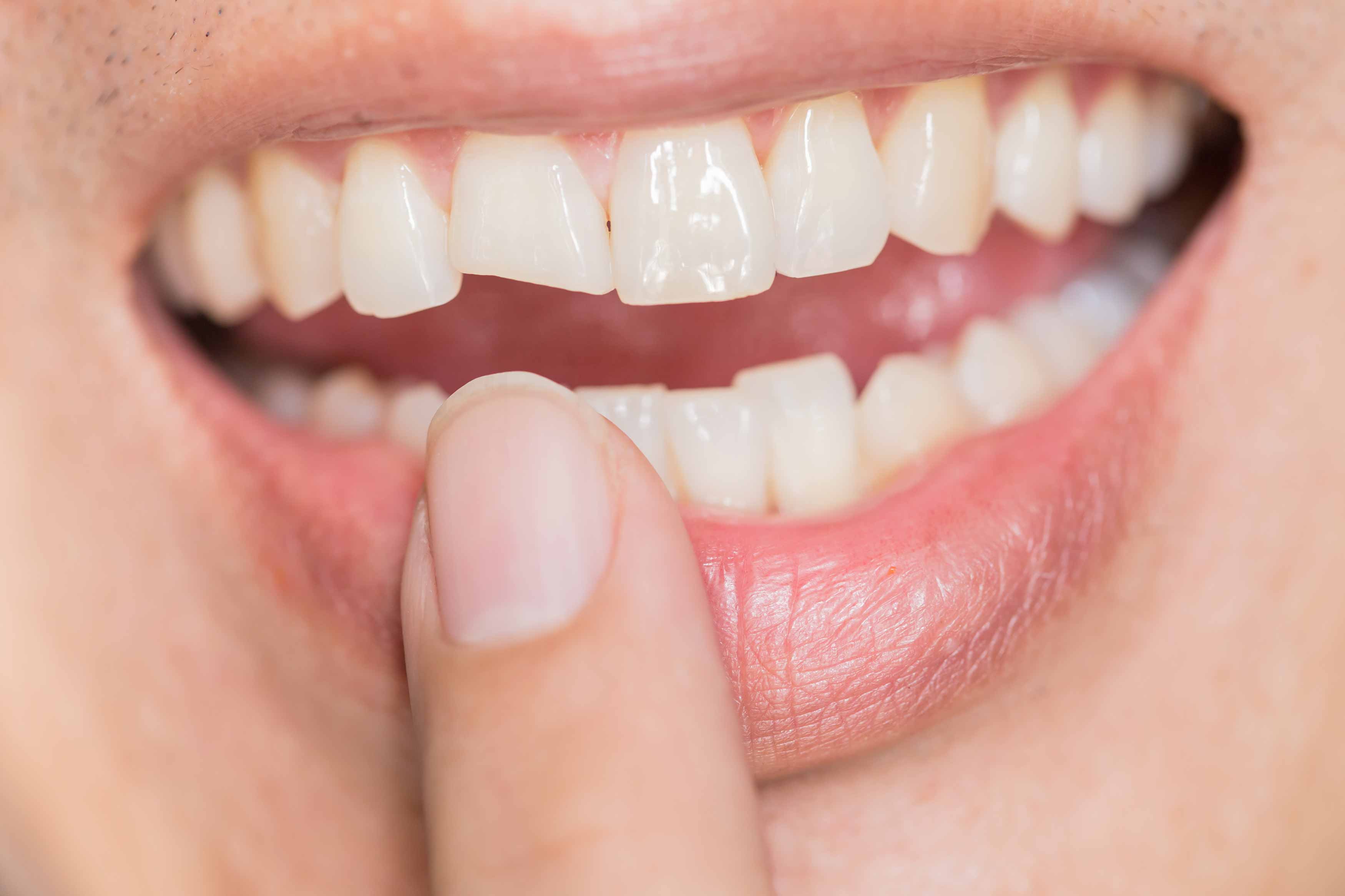 Upclose photo of someone's teeth showing the bottom part of their upper right central incisor fractured
