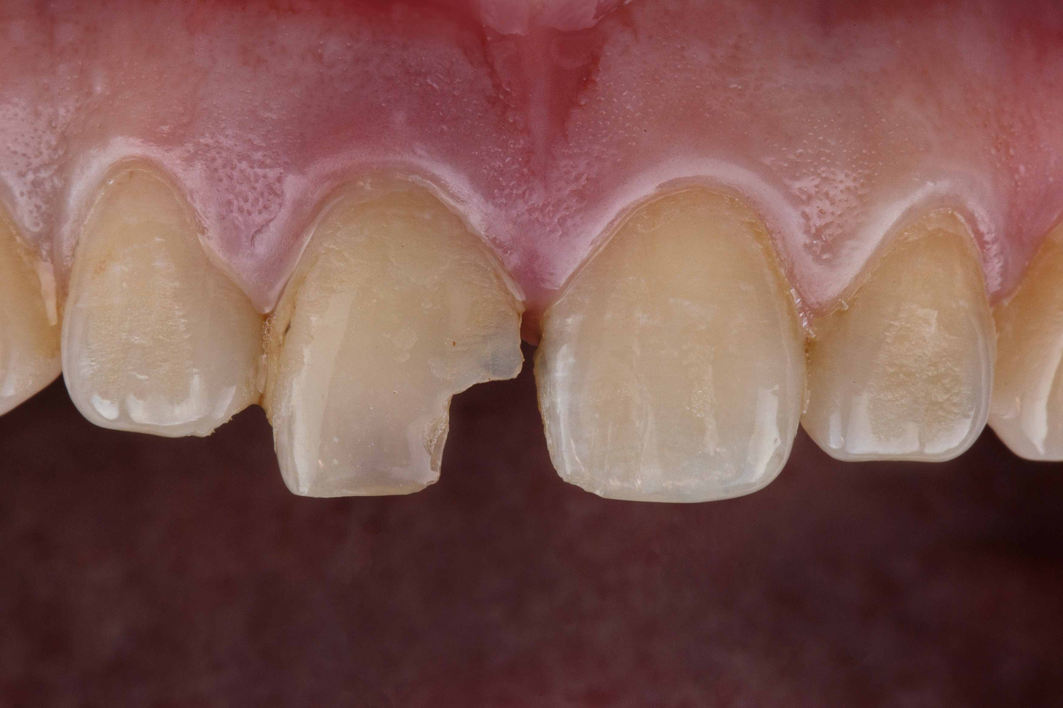 Upclose photo of someone's teeth showing the bottom part of their upper right central incisor fractured