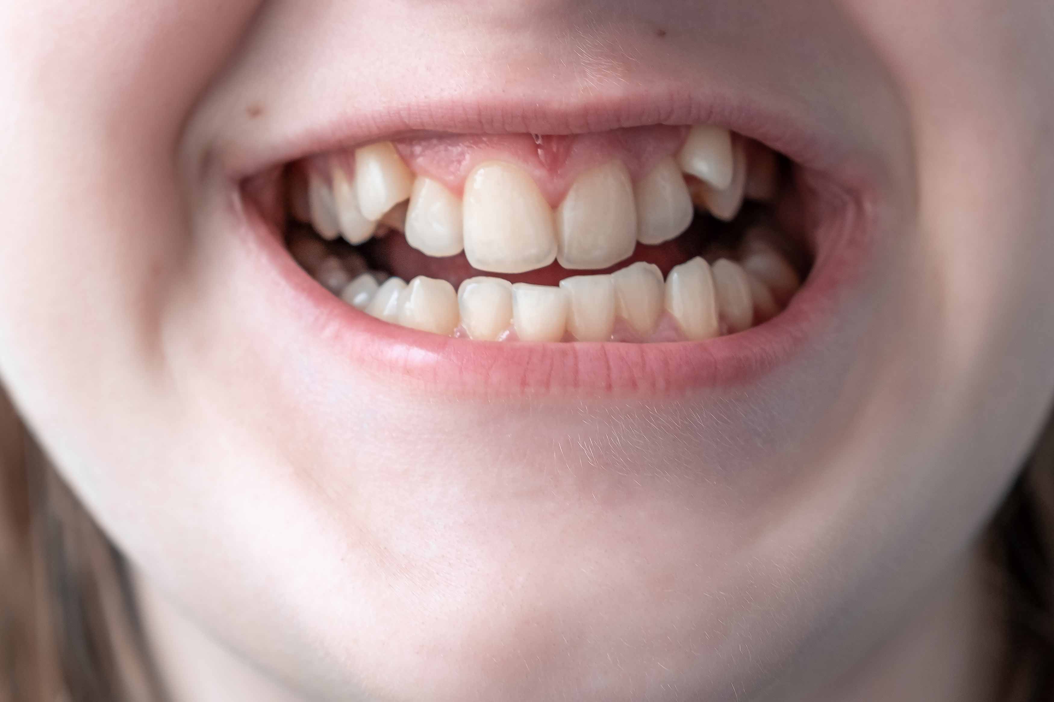 a photo showing someone smiling. their upper teeth are very crowded and crooked with the upper canines erupting through from the gums infront of their other teeth