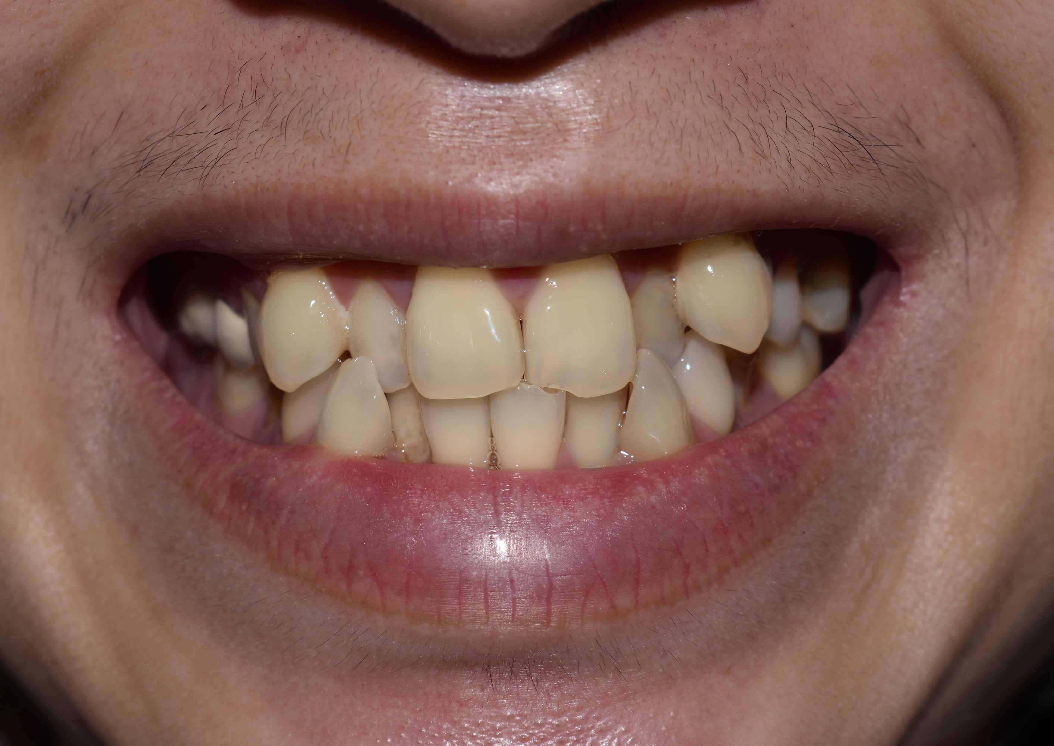a closeup photo showing someone smiling. their upper and lower teeth are very crowded and crooked. they have multiple teeth overlapping each other, this results in a malocclusion