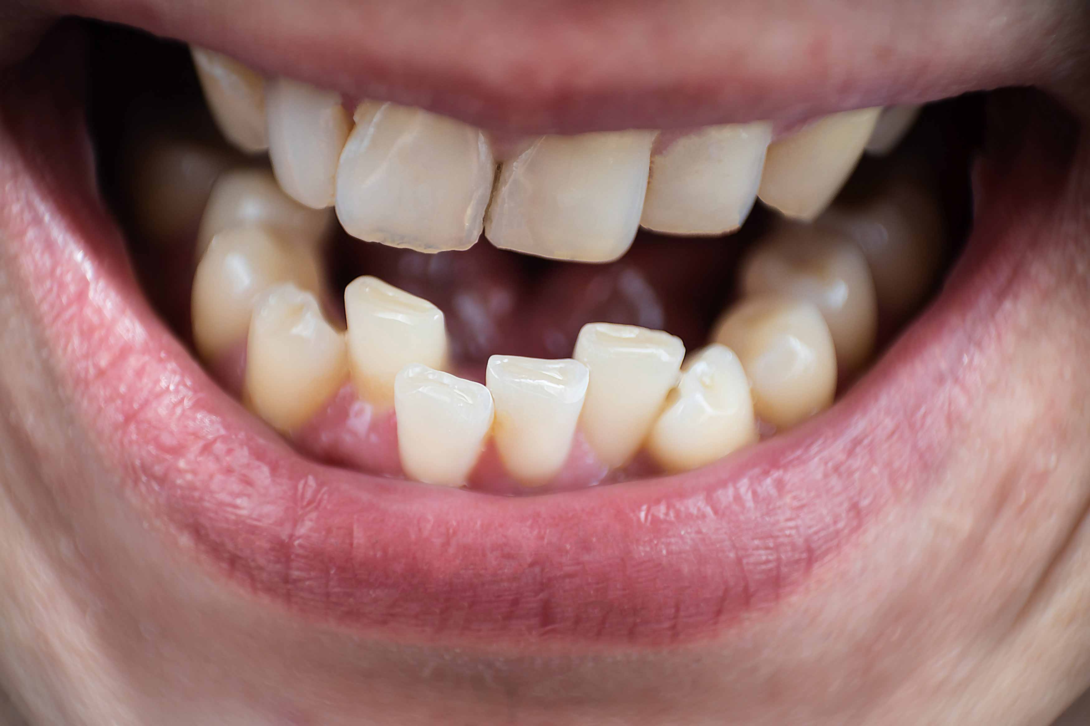 a closeup photo showing someone smiling. their lower teeth are very crowded and are overlapping each other due to lack of space and room
