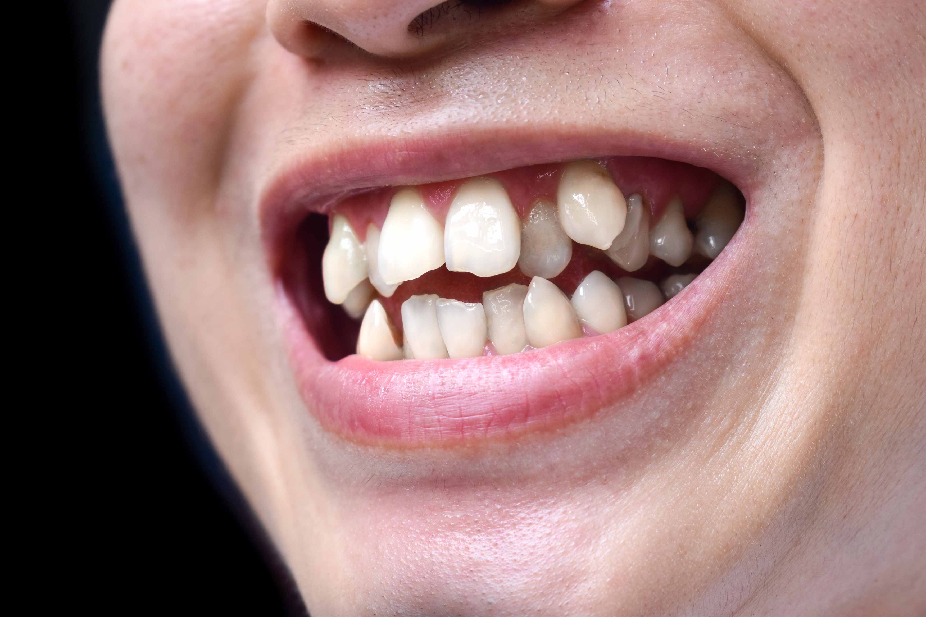 a side-closeup photo showing someone smiling. their upper and lower teeth are very crowded and crooked. they have multiple teeth overlapping each other, and are in crossbite with their front teeth