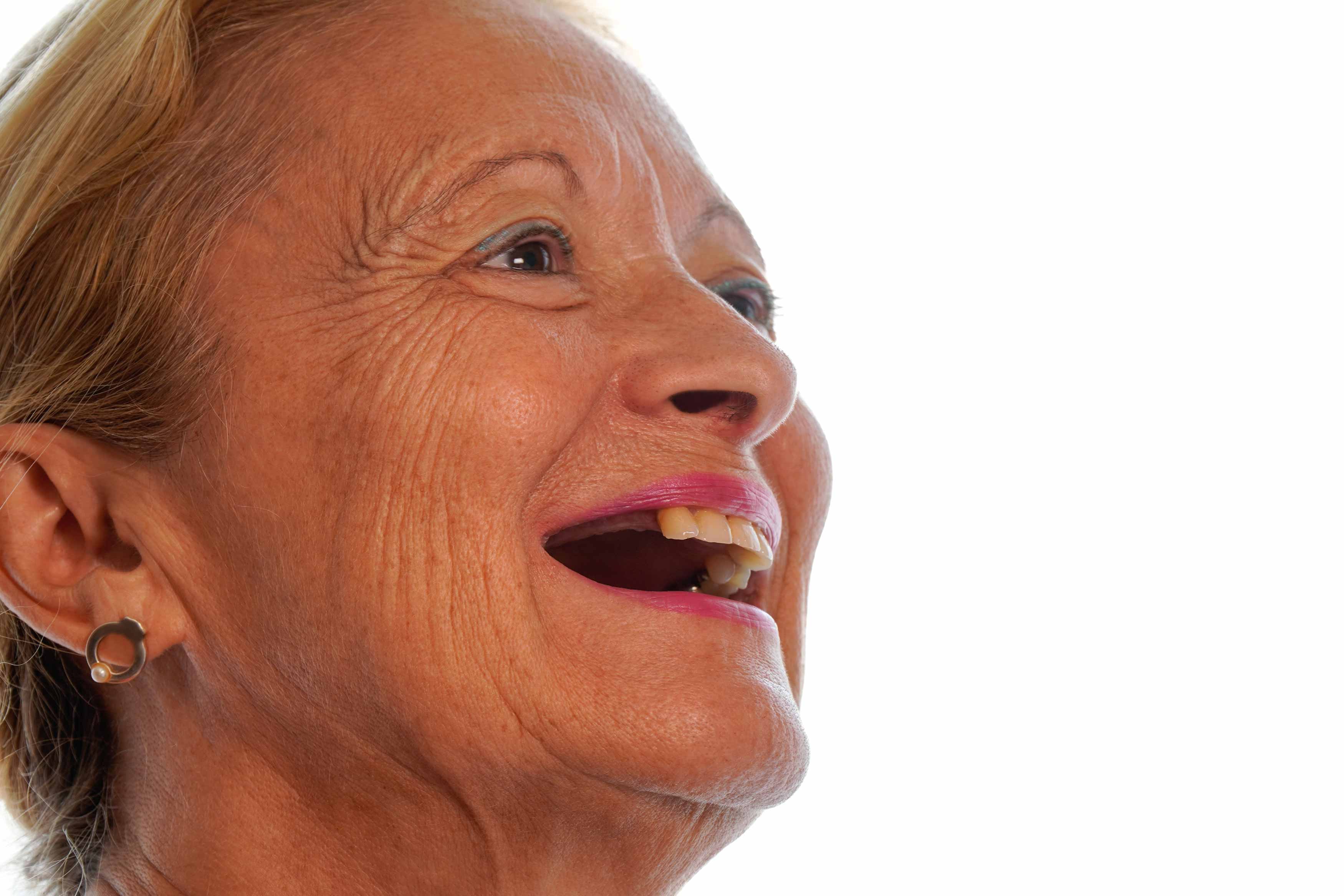 A photo of an elderly female smiling showing she has multiple missing upper right teeth