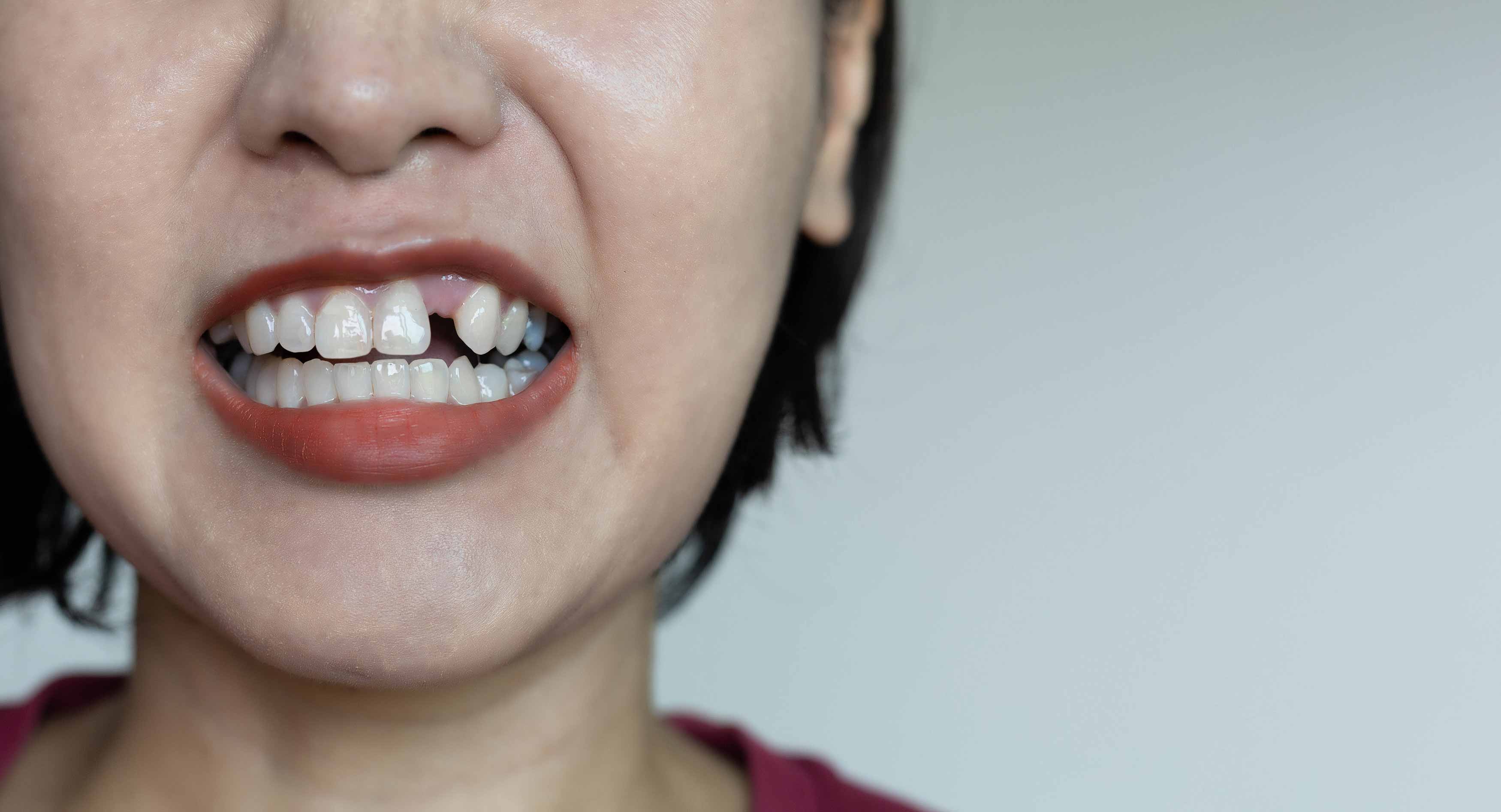 A photo of a female smiling showing she has a missing front tooth
