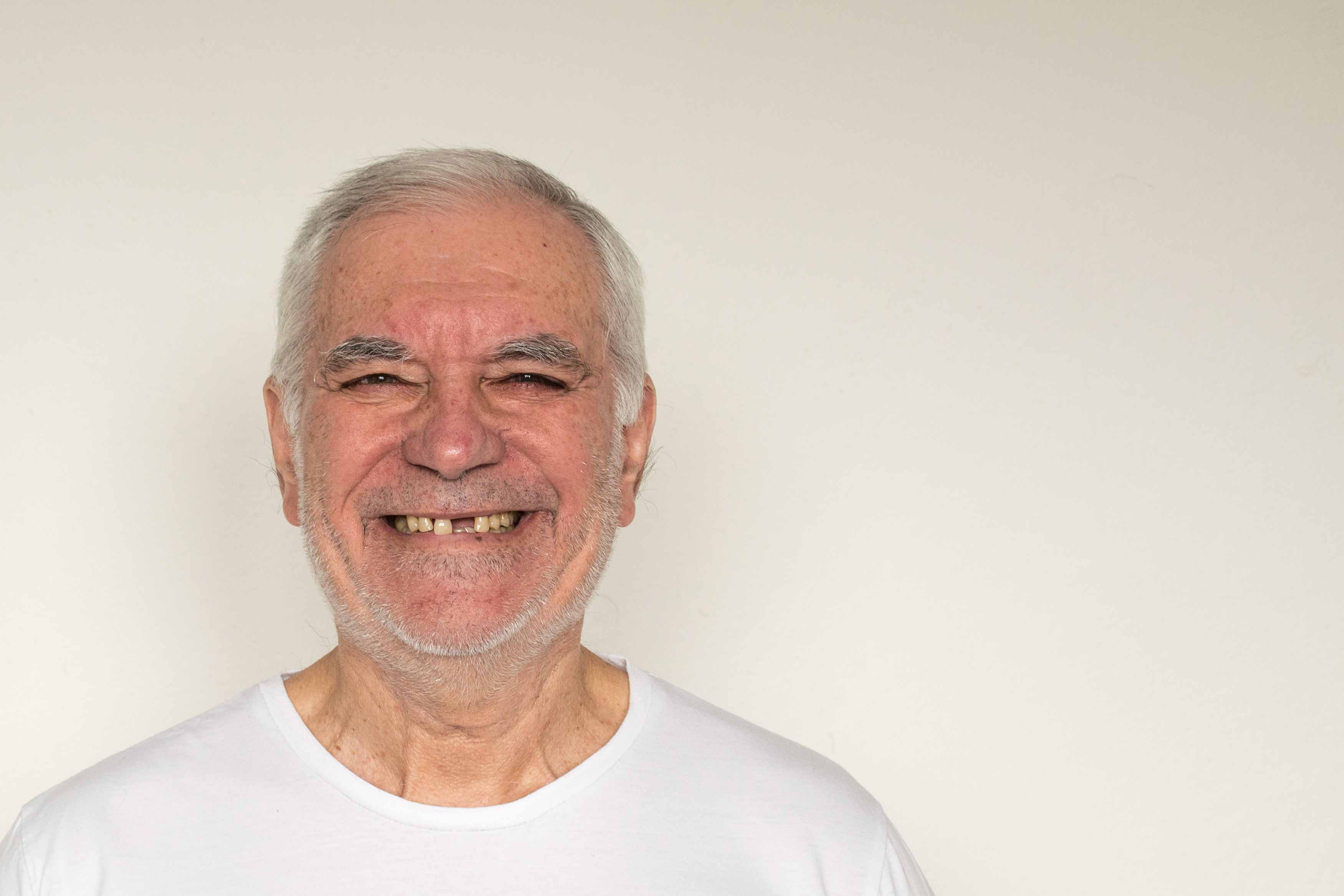 A photo of an elderly male smiling showing he has a missing front tooth 