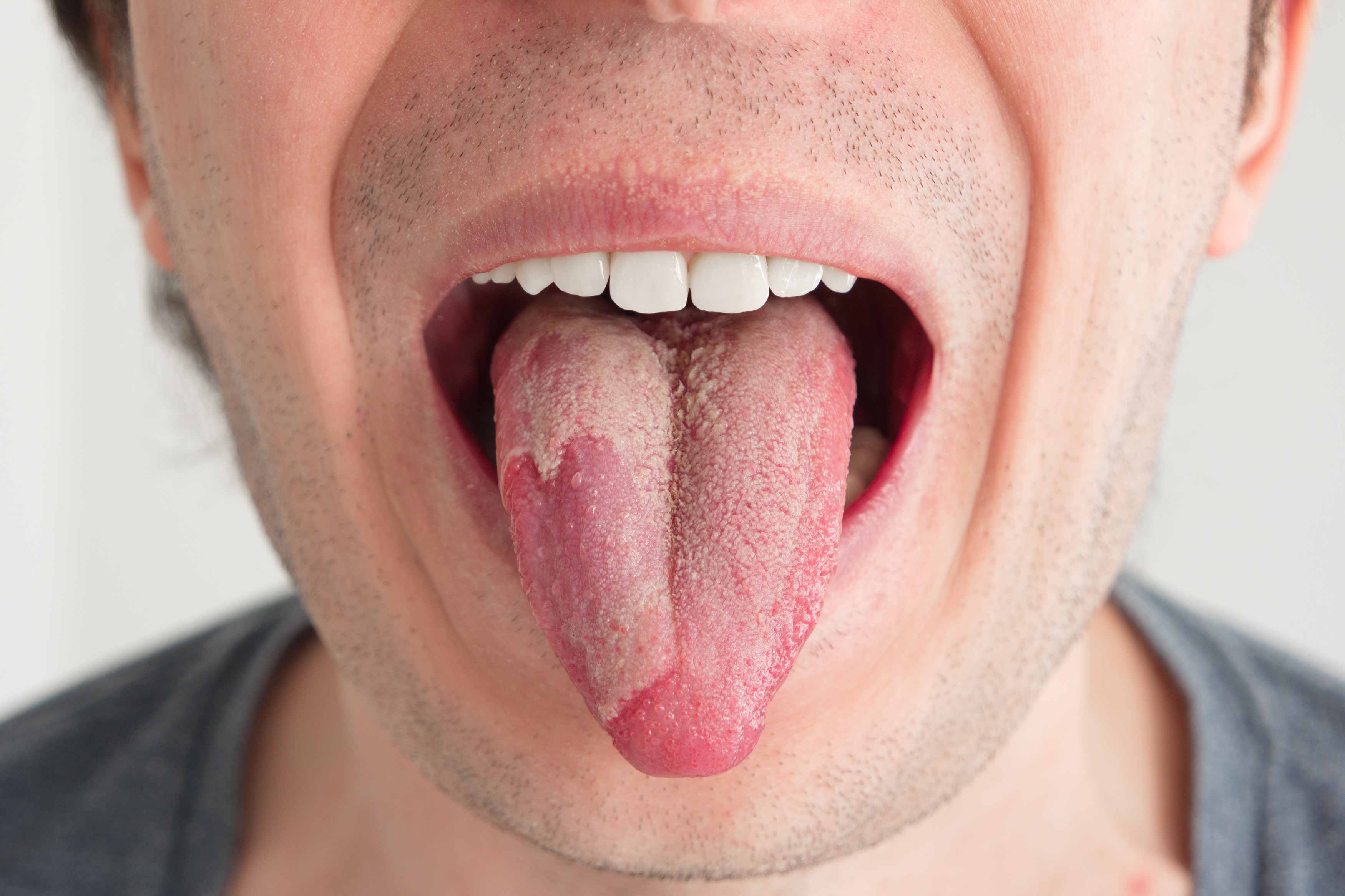 Photo of someone sticking their tongue out and showing oral thrush on the side of their tongue