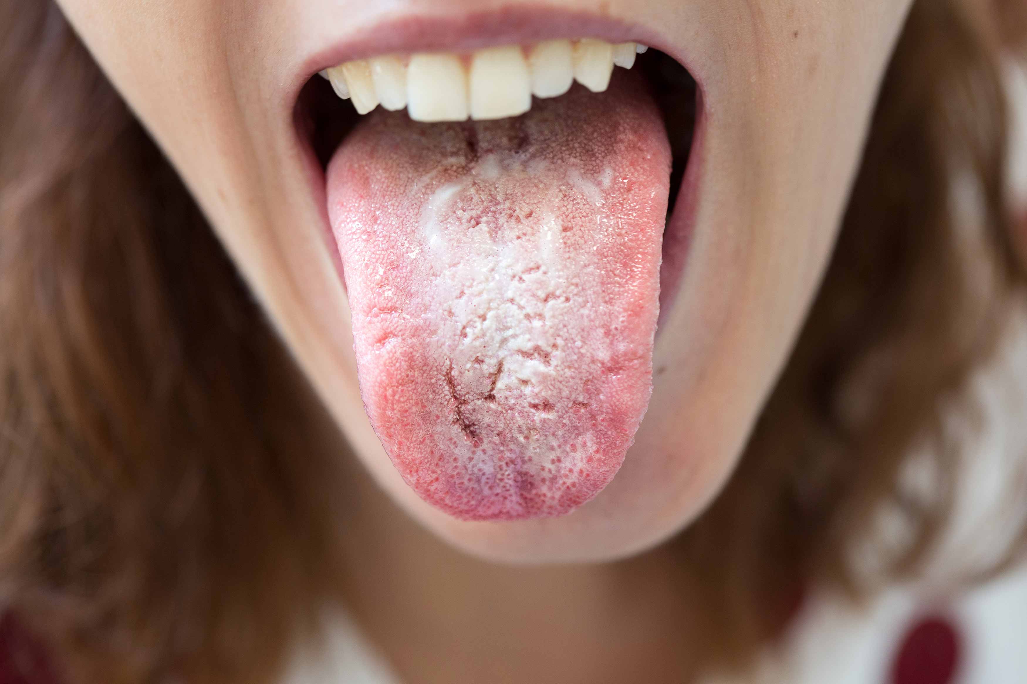 Photo of someone sticking their tongue out and showing oral thrush on the side of their tongue