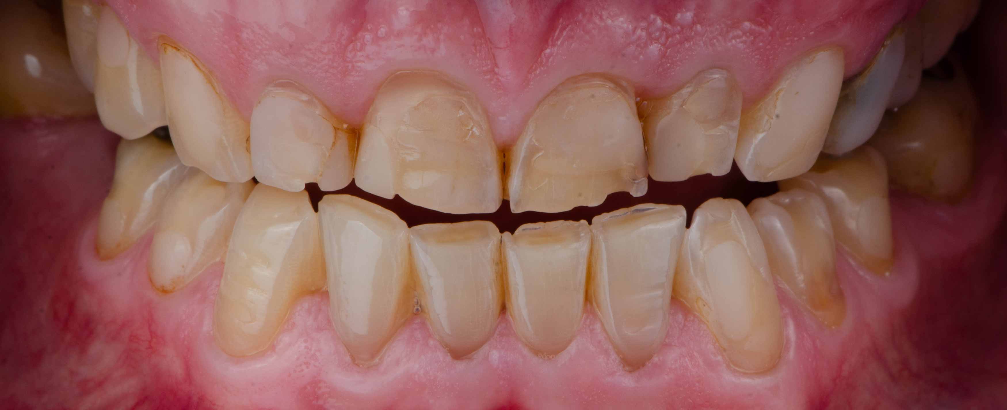 a closeup photo of an upper and lower teeth showing chipped and grounded down teeth. 