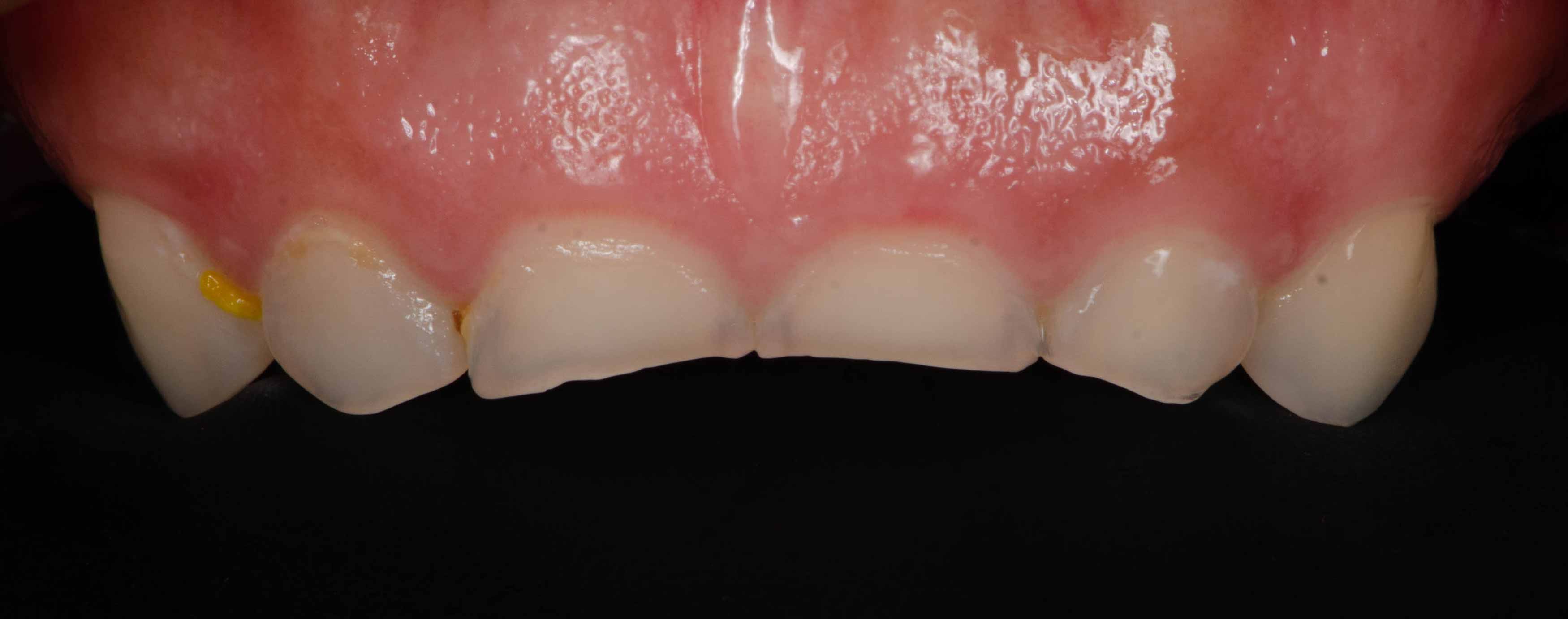 a closeup photo of 6 front baby teeth which are really short and worn down by grinding