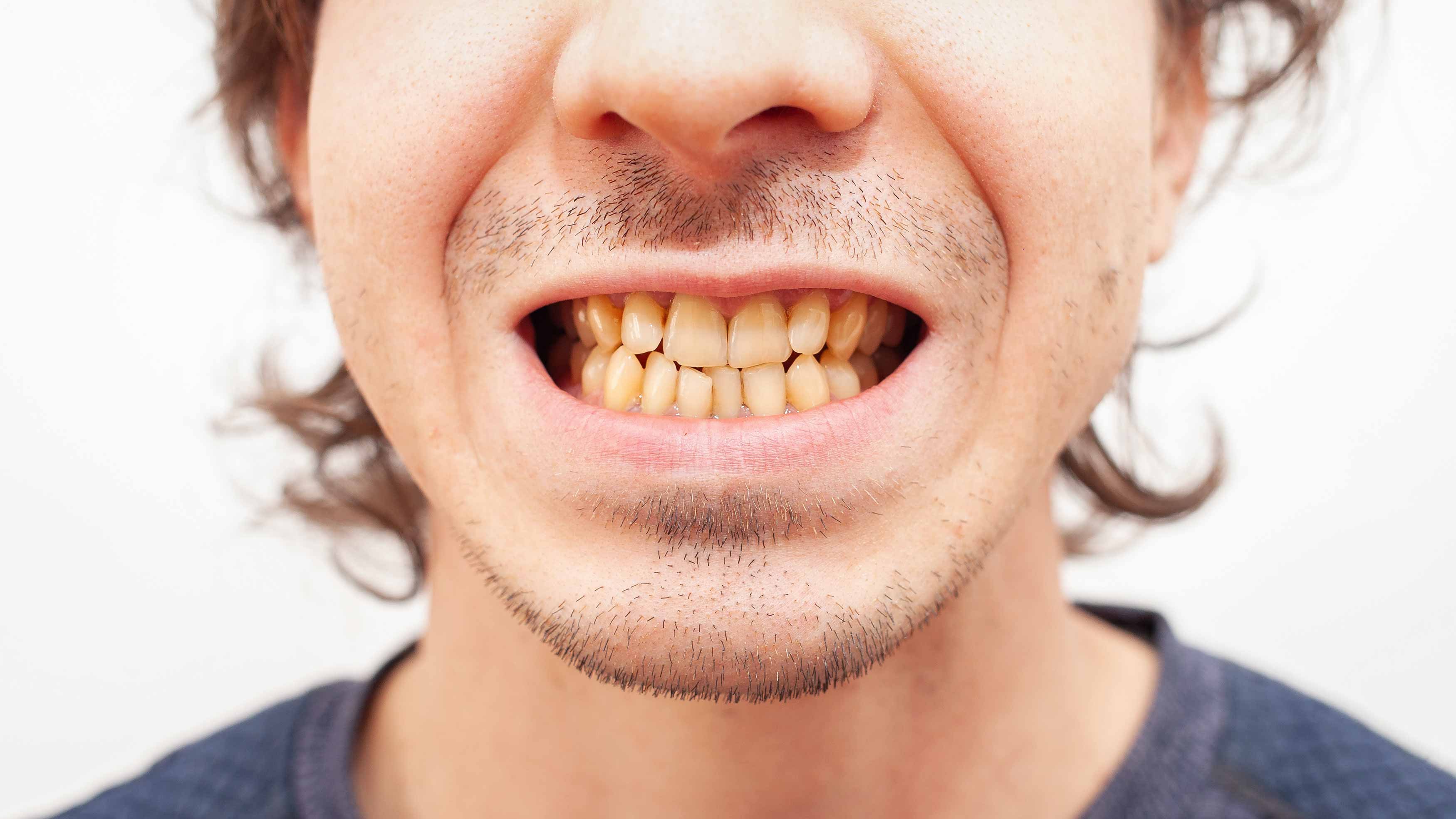 a smile photo showing someone's teeth which are quite yellow and stained