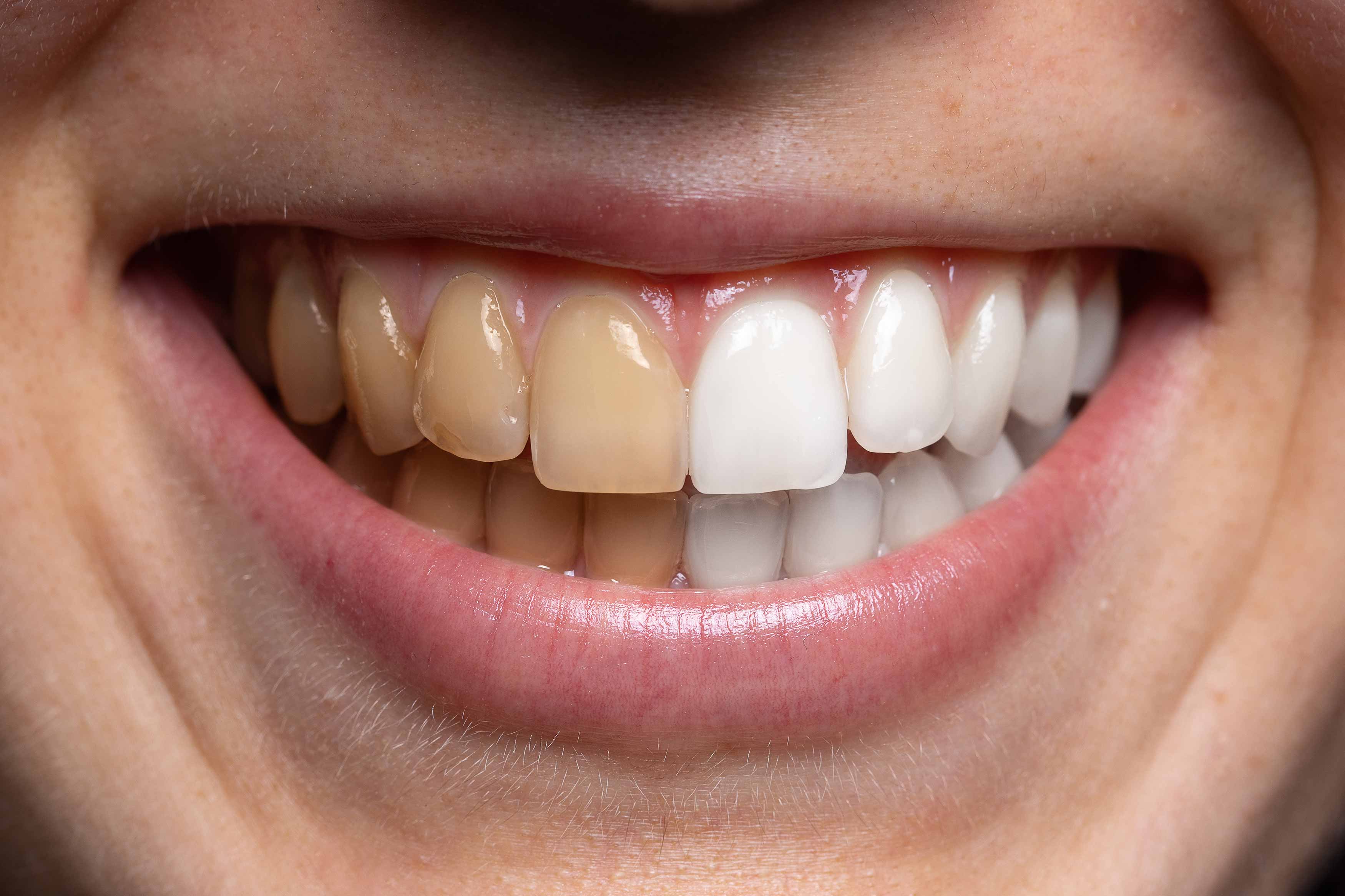 a smile photo showing the right half of their upper and lower teeth being yellow while the left half being really white