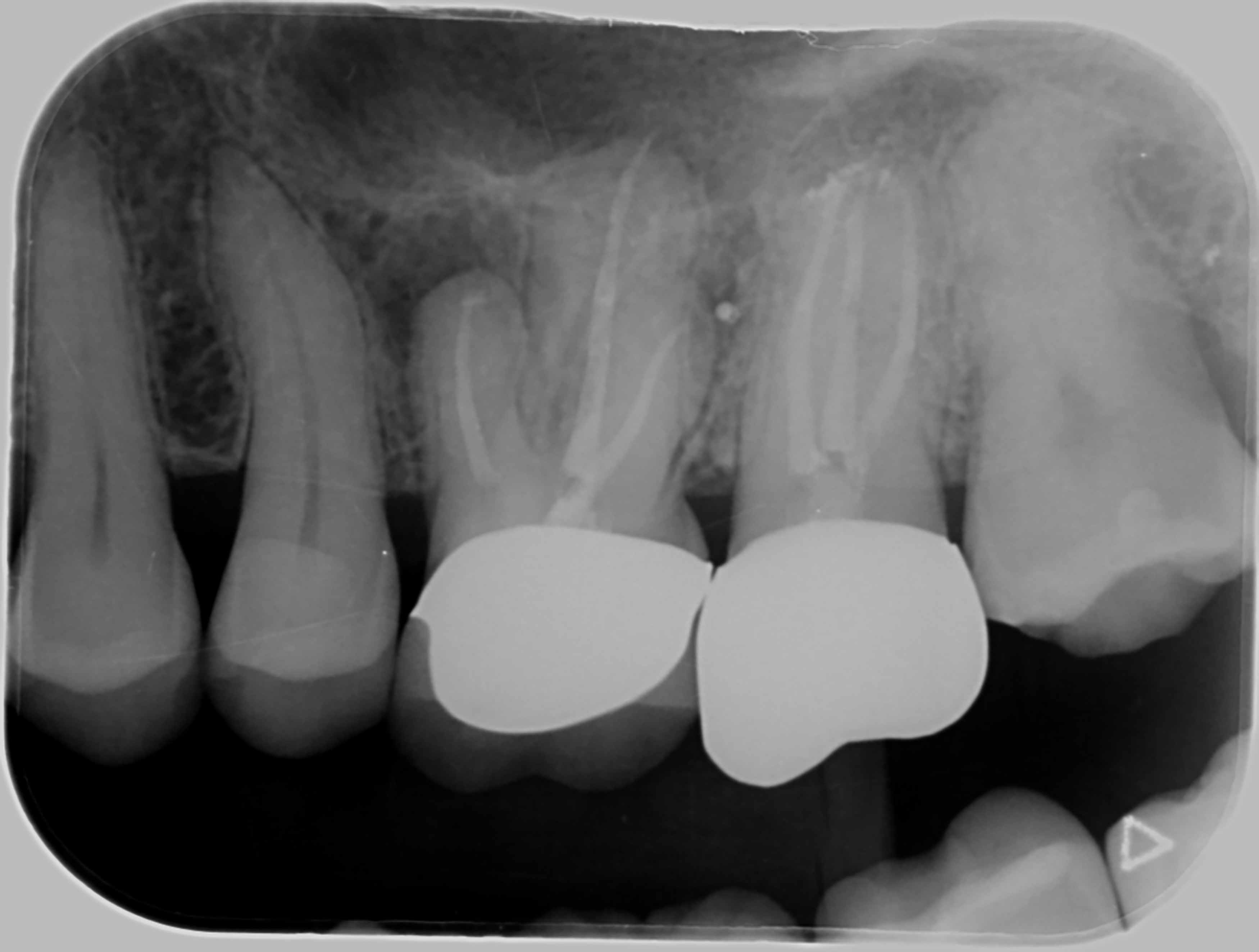 A Xray taken of post-endodontic treatment showing multiple molars that has been obturated and endodontically treated