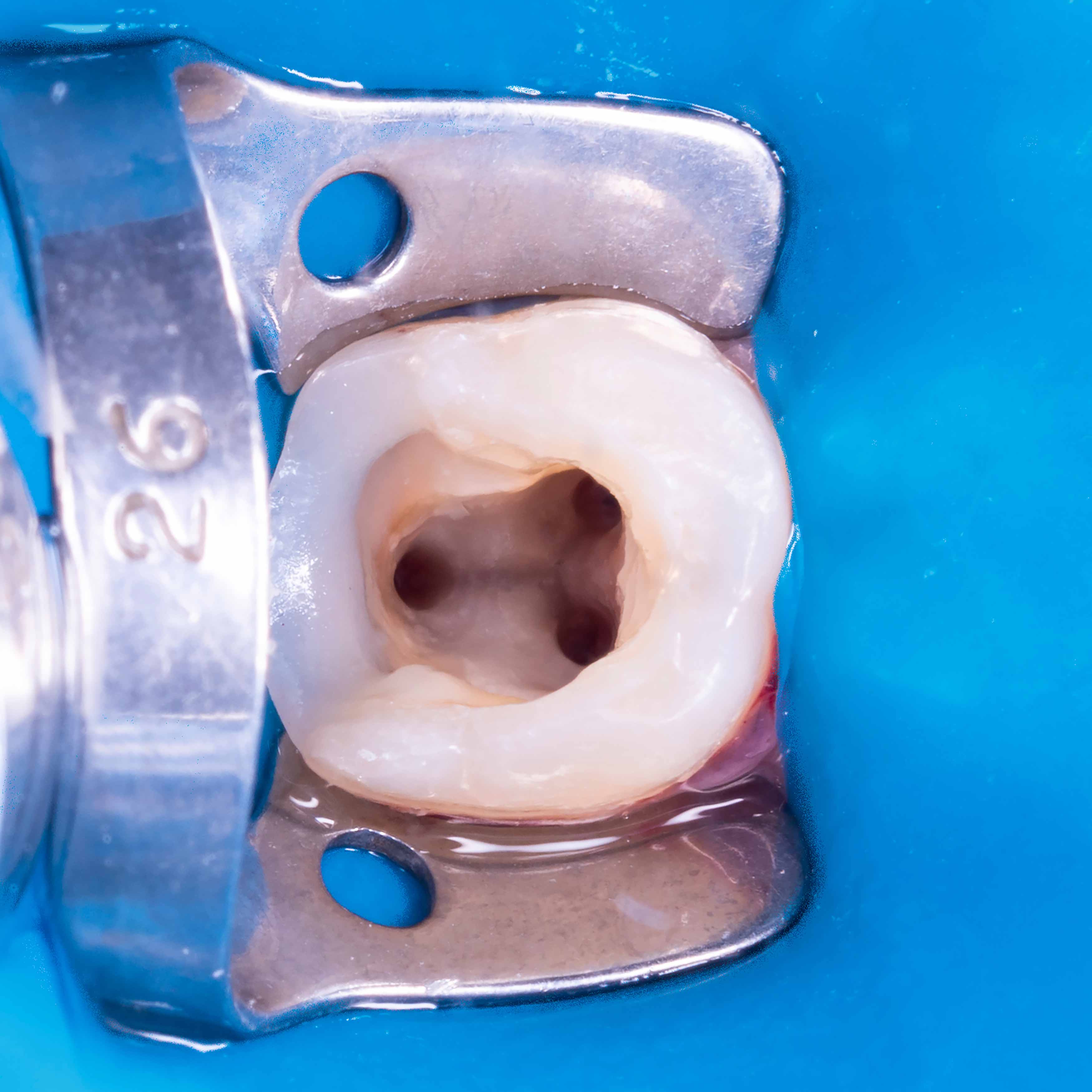 A photo of a lower molar undergoing a root canal treatment (endodontic treatment) with 3 canals cleaned out and using a rubber dam for isolation.