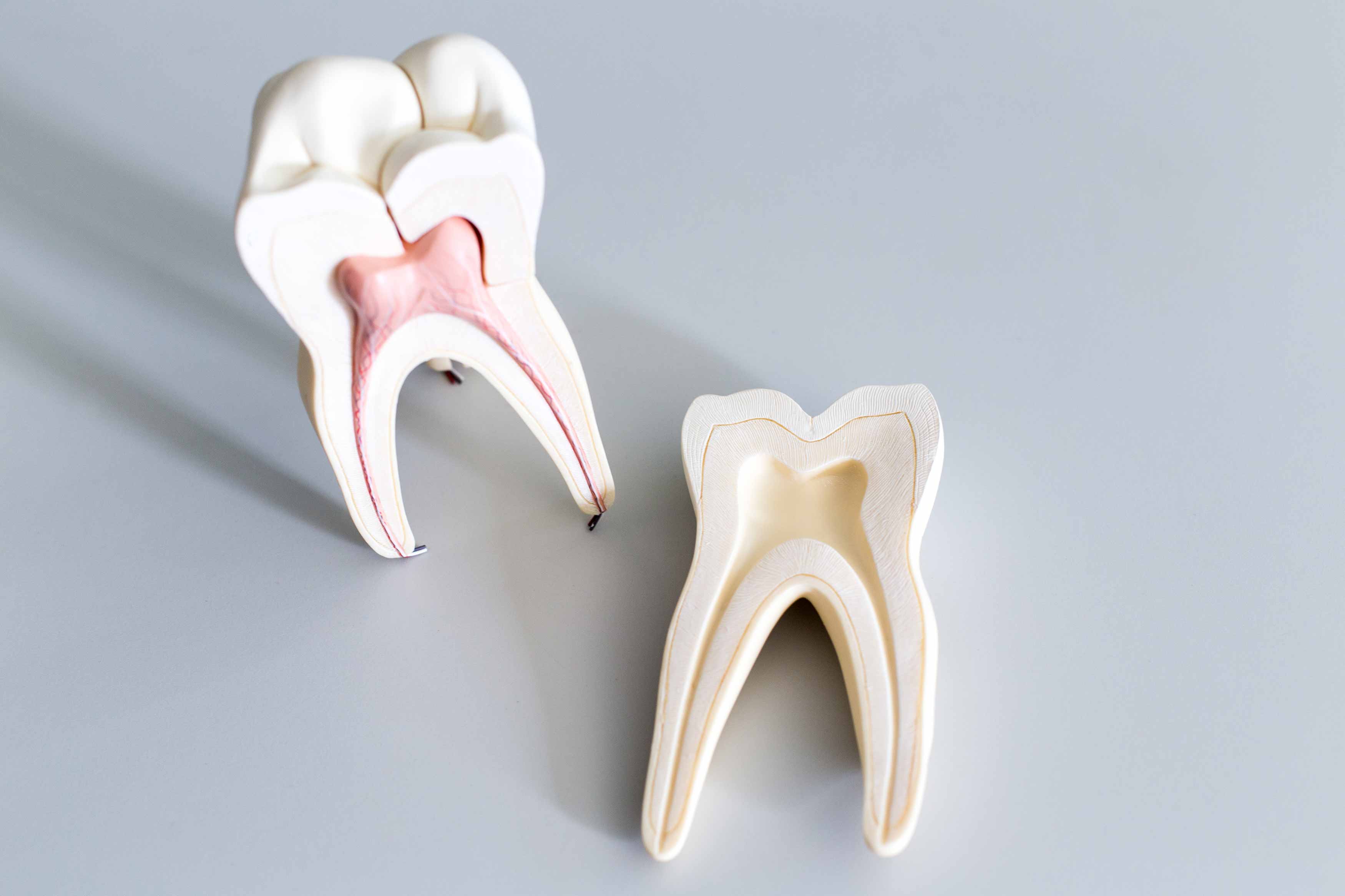 A photo of 2 lower molar figures showing one with a nerve and one without a nerve 