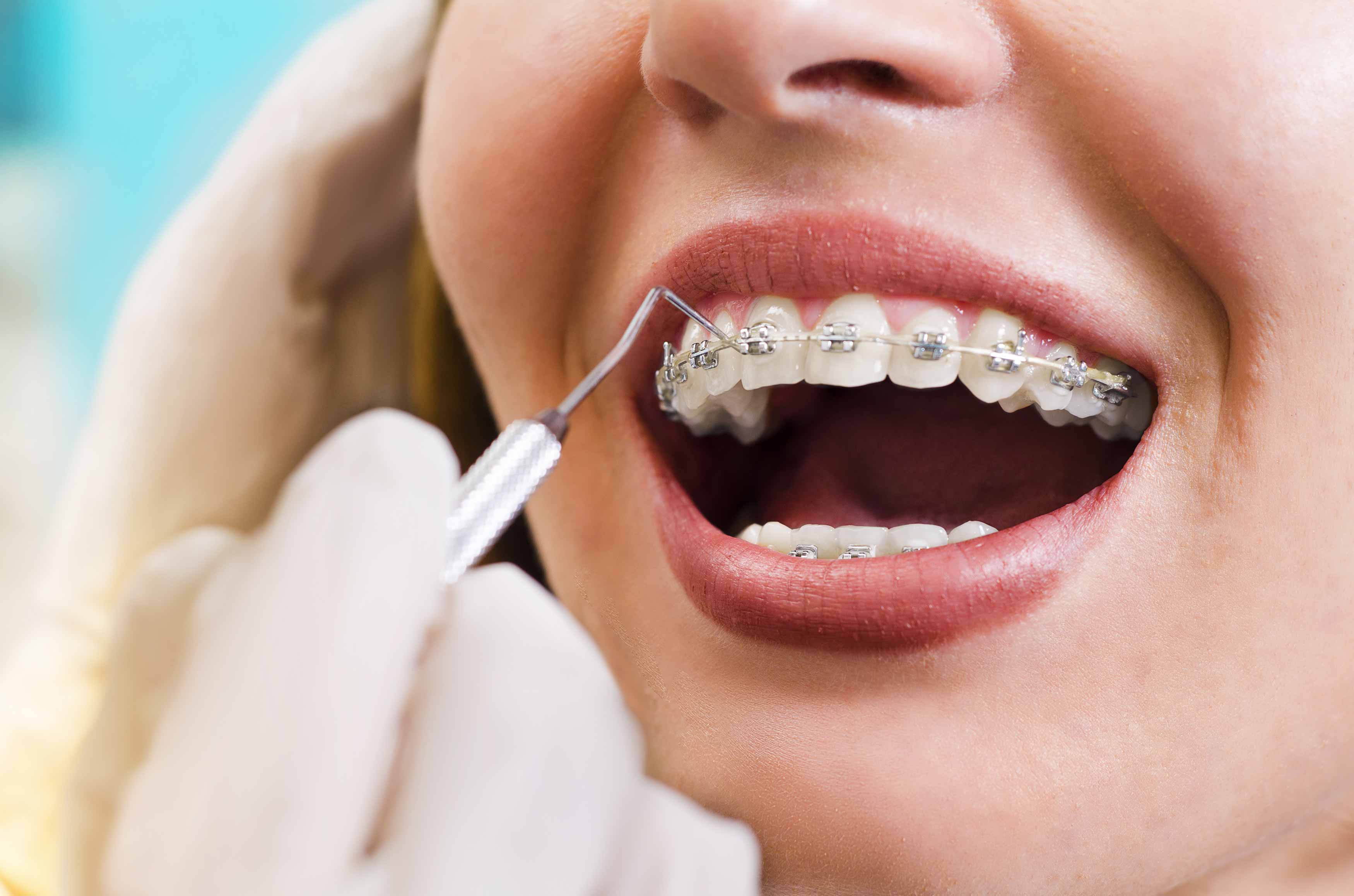 a photo of someone who has braces placed on her upper teeth