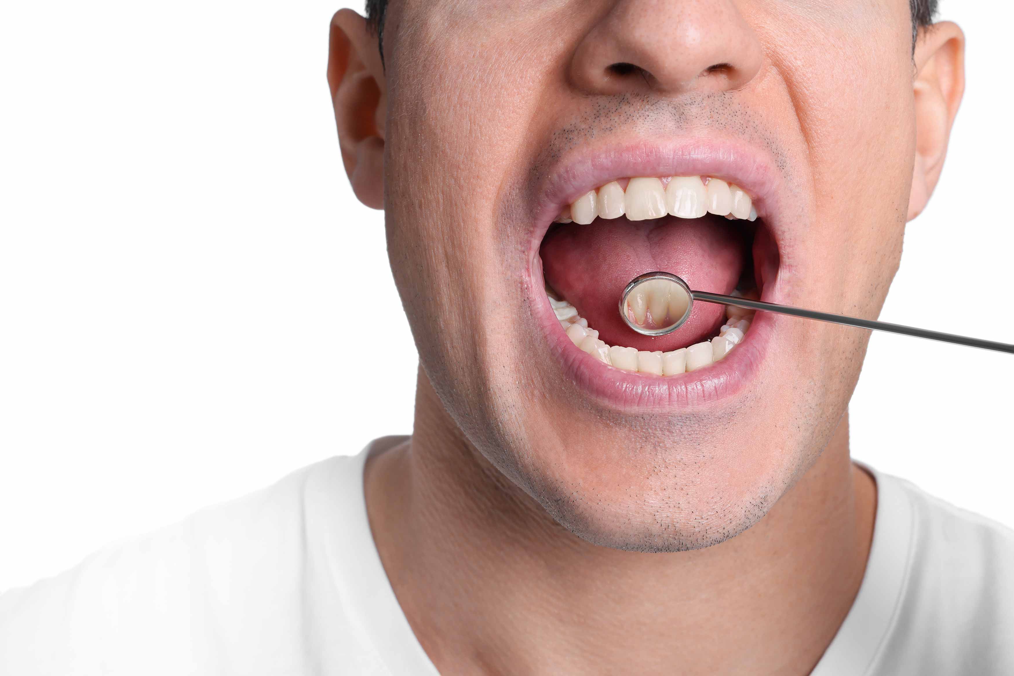 A photo of a male with his mouth wide open so a dental mirror is placed to check for oral cancer under his tongue