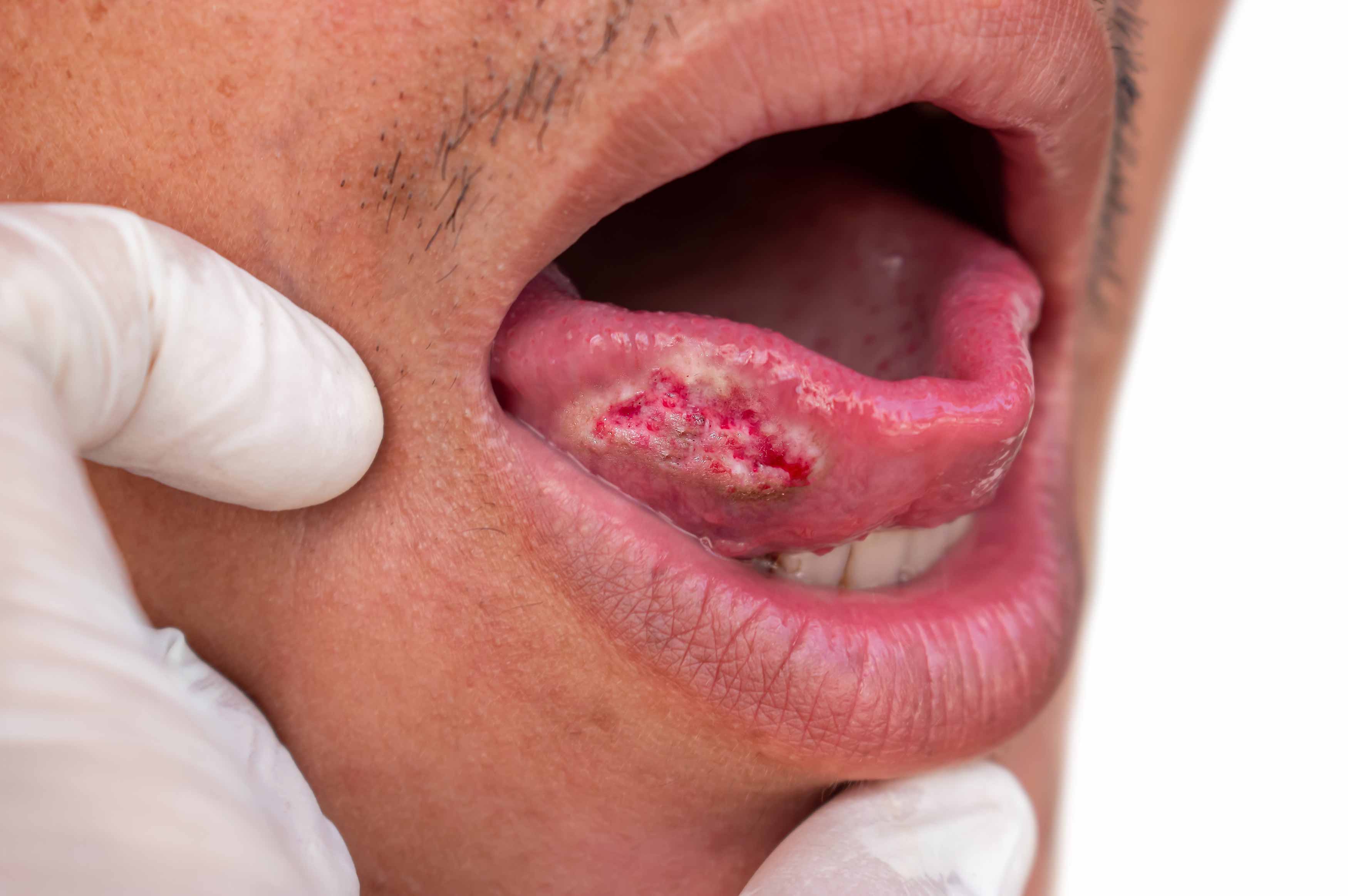 Photo of a cancer on the right side of someone's tongue
