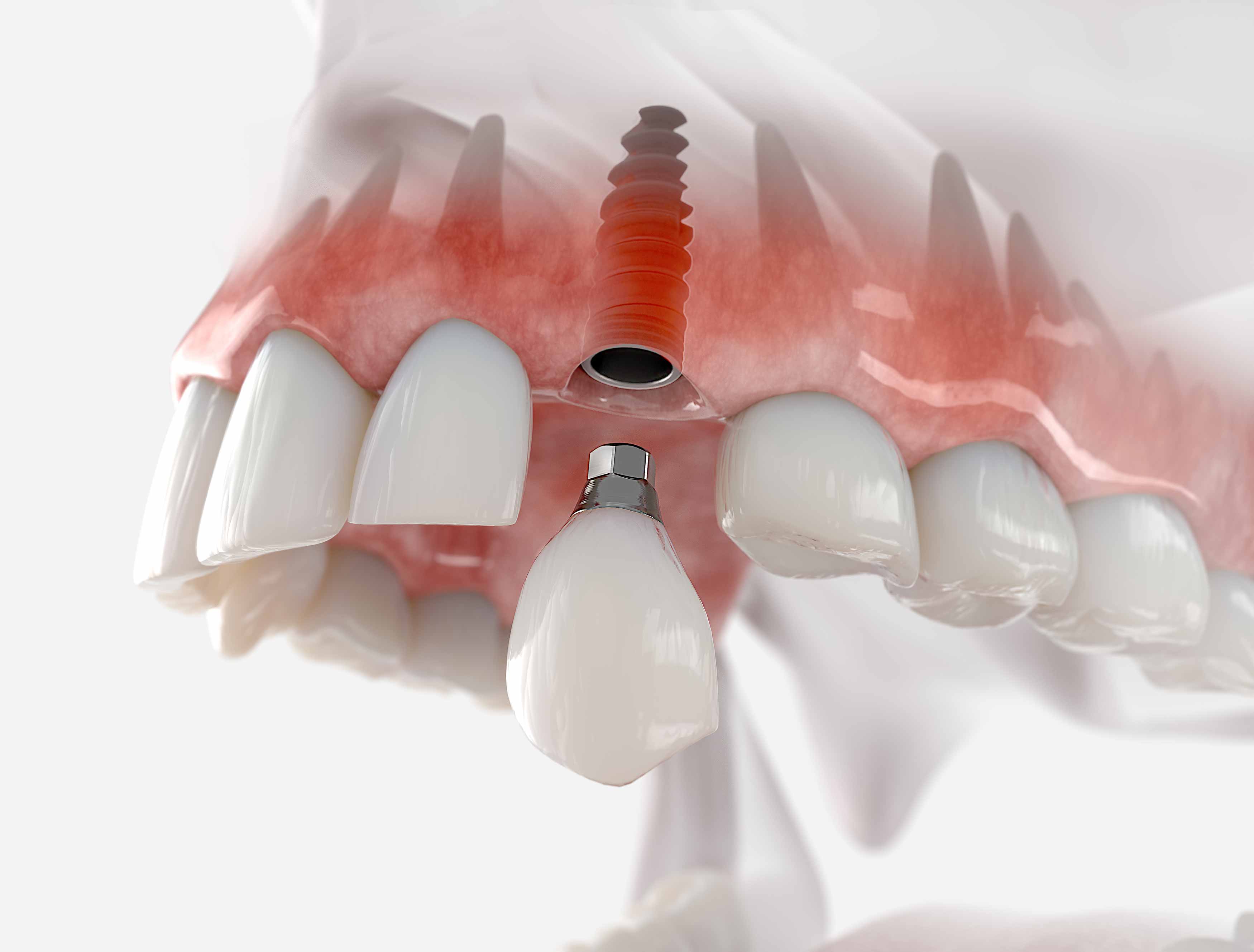 A picture showing a dental implant in the upper jaw with a porcelain implant crown attached to the dental implant in the jaw