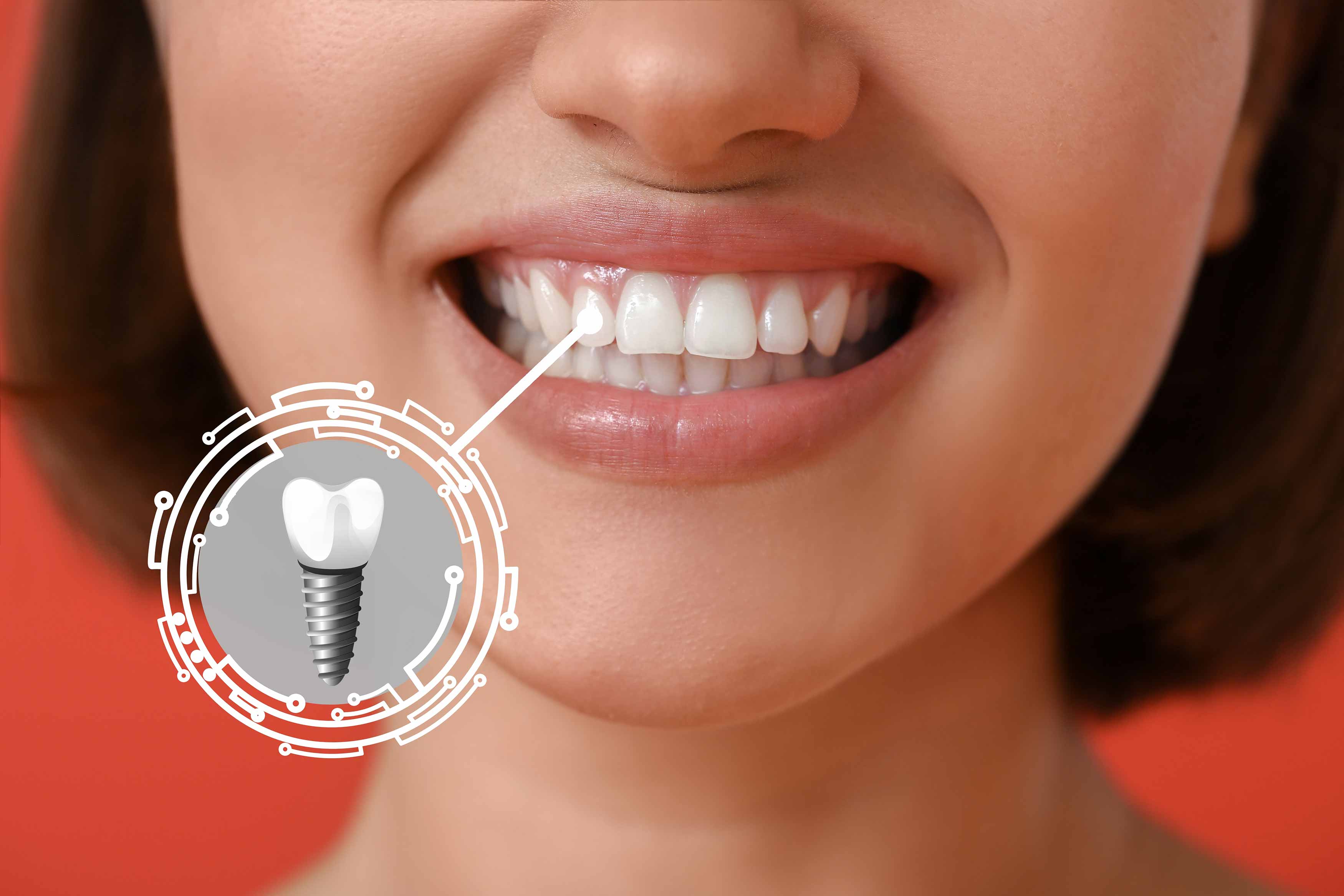 A photo of a female smiling and showing his front lateral incisor that has been replaced by a dental implant crown
