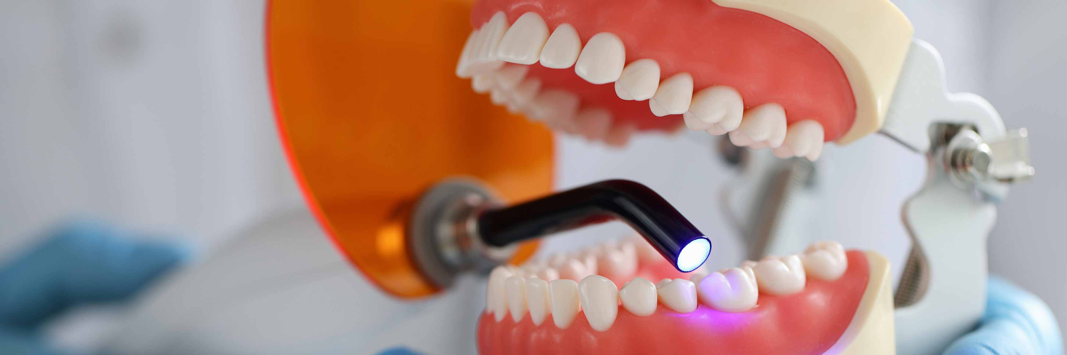 A photo of an UV light used to cure composite resin that is on a tooth model