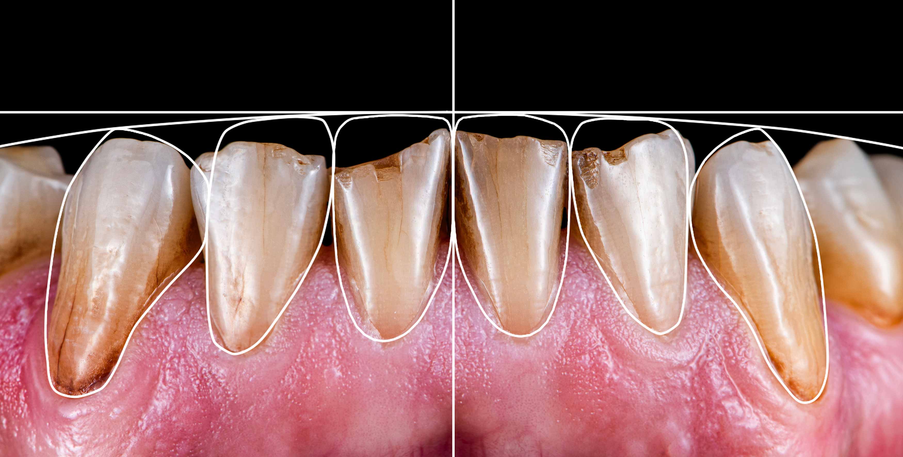 A photo showing mockup of an ideal toothshape and height compared to the existing worn teeth. 