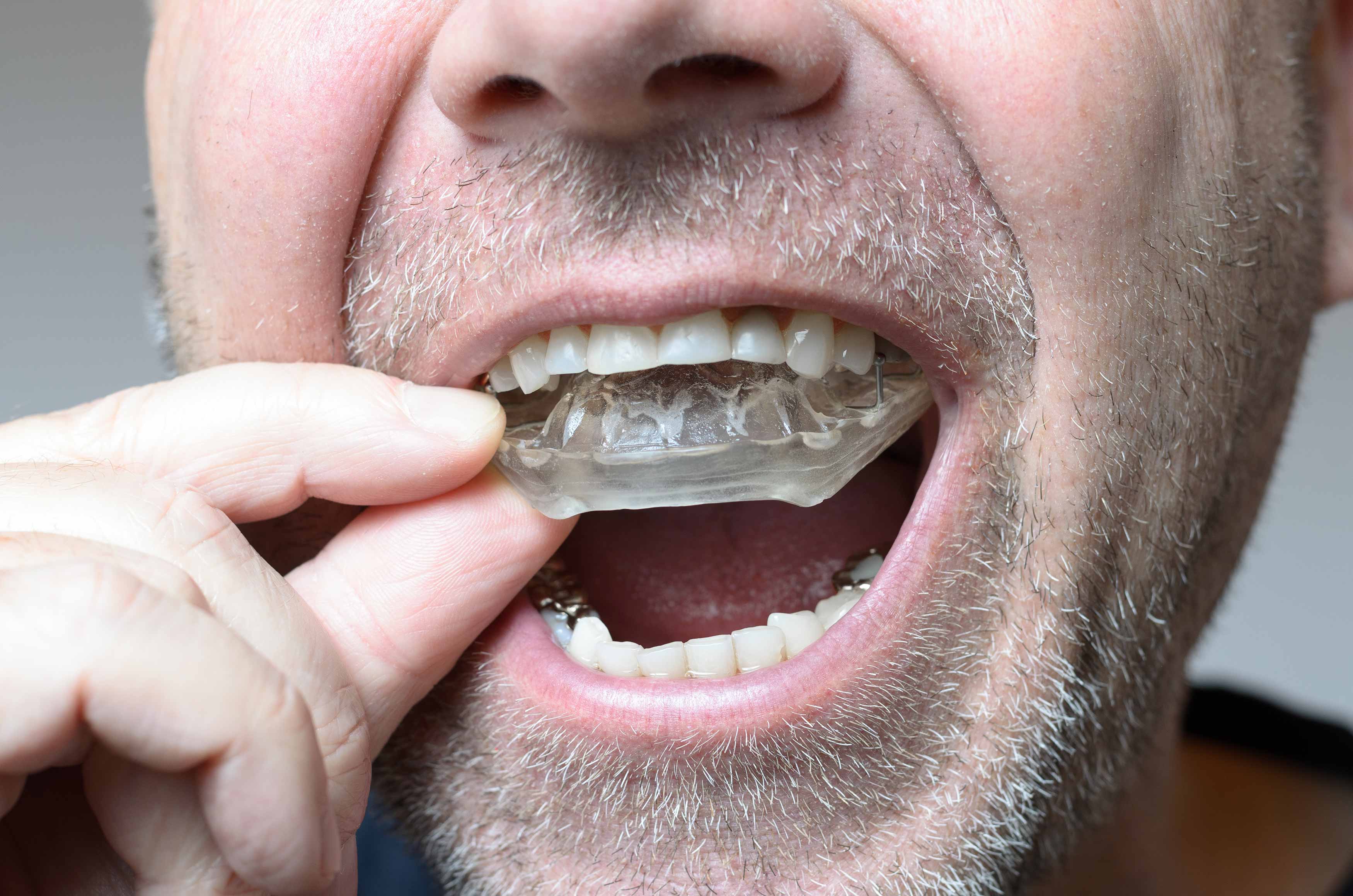 A dental appliance placed in someone's mouth to help with noctural bruxism and grinding